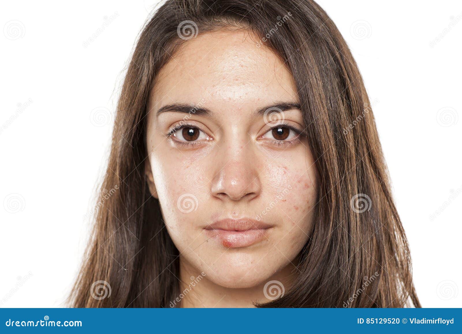 Acne and herpes stock photo. Image of beautiful, face 85129520