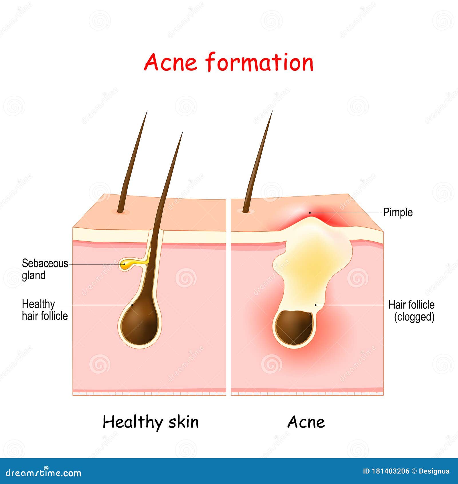 Folliculitis  Cause Symptoms  Treatment  Traya