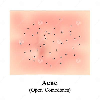 Acne, Open Comedones. Skin with Blackheads. Black Spots. Acne on the ...