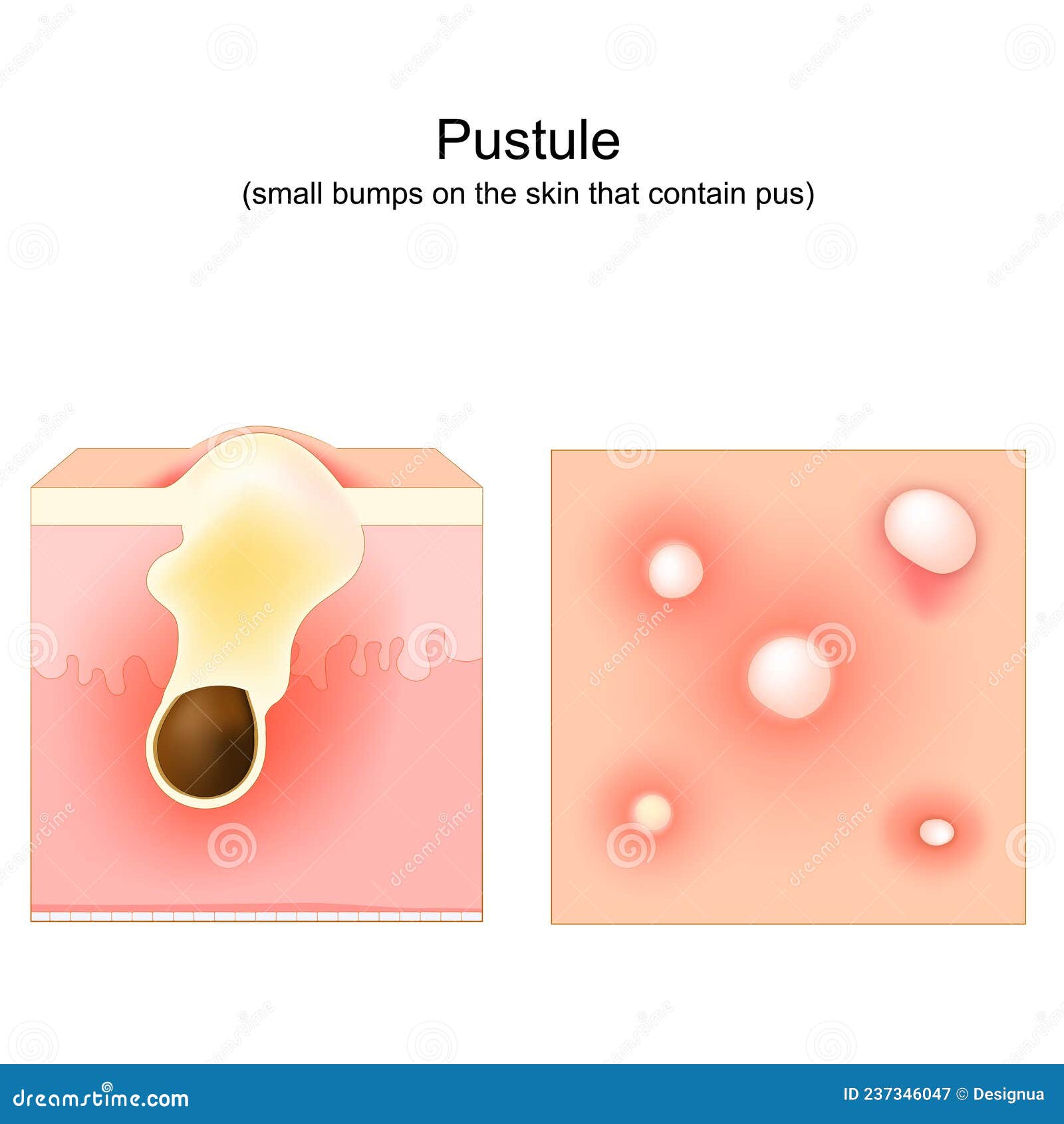 Acne. Pustule. Cross-section of a Human Skin. Hair Follicle with Pus Stock  Vector - Illustration of pimples, medicine: 237346047