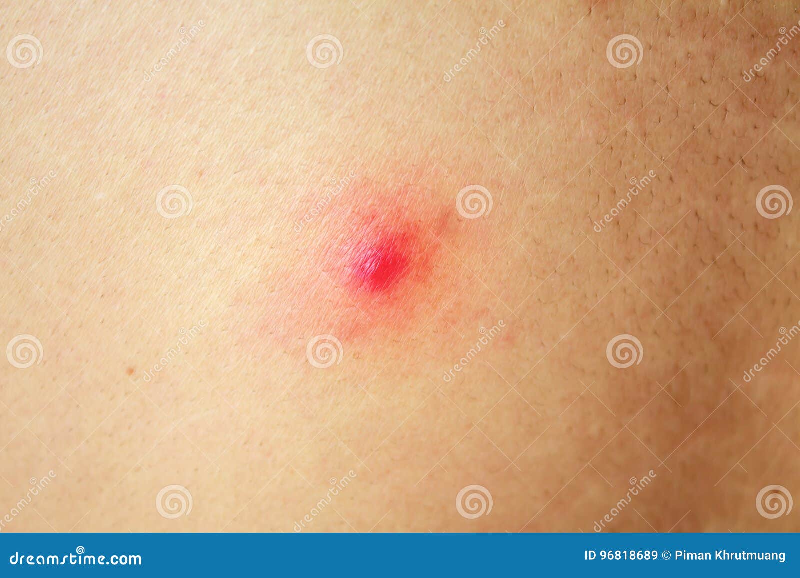 Acne with red spots stock image. Image of back, medical 96818689