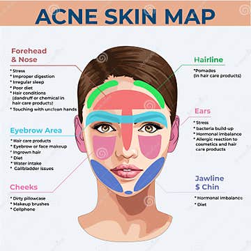 Acne Skin Map.Dermatology Infographic Stock Illustration - Illustration ...