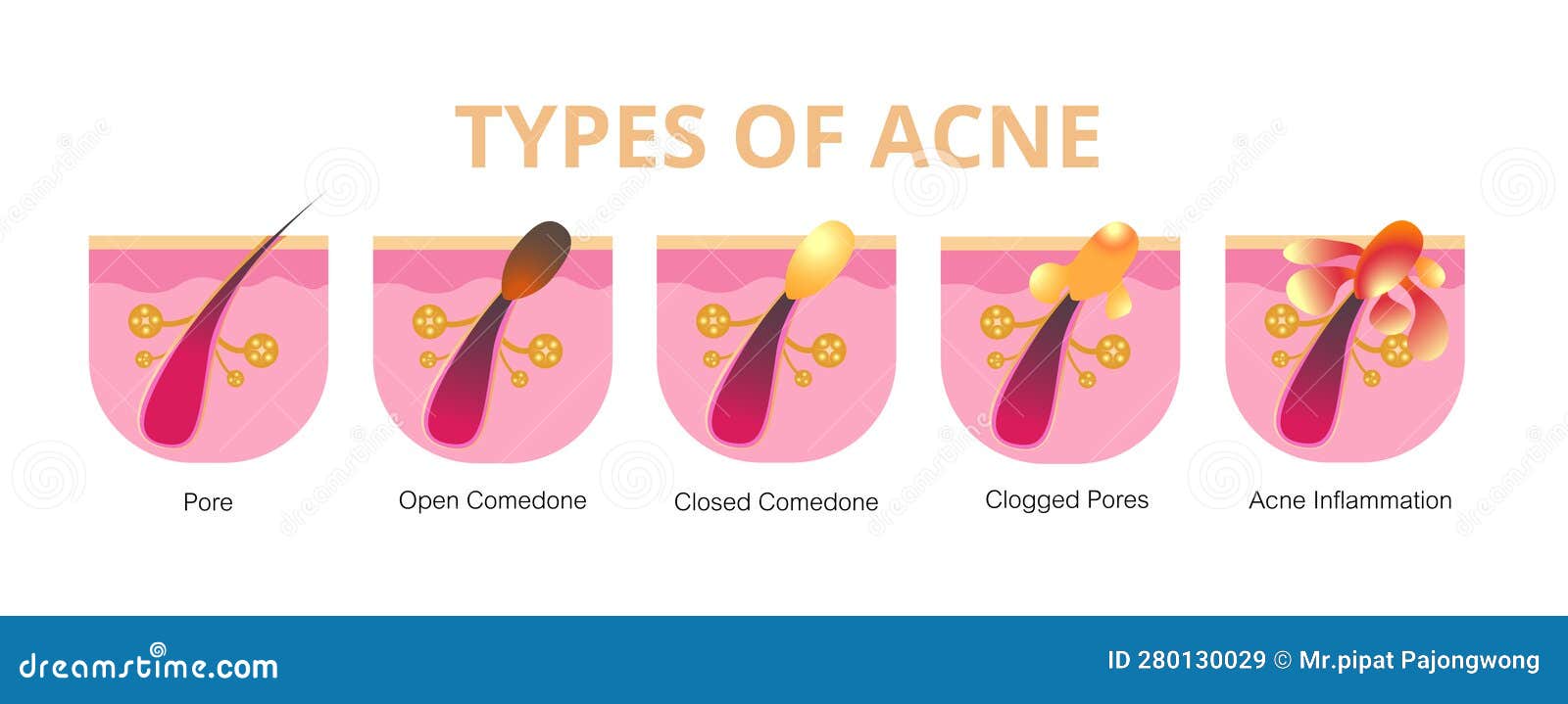 Acne Development Stages. Inflamed Skin Pimples. Plugged Hair Follicles