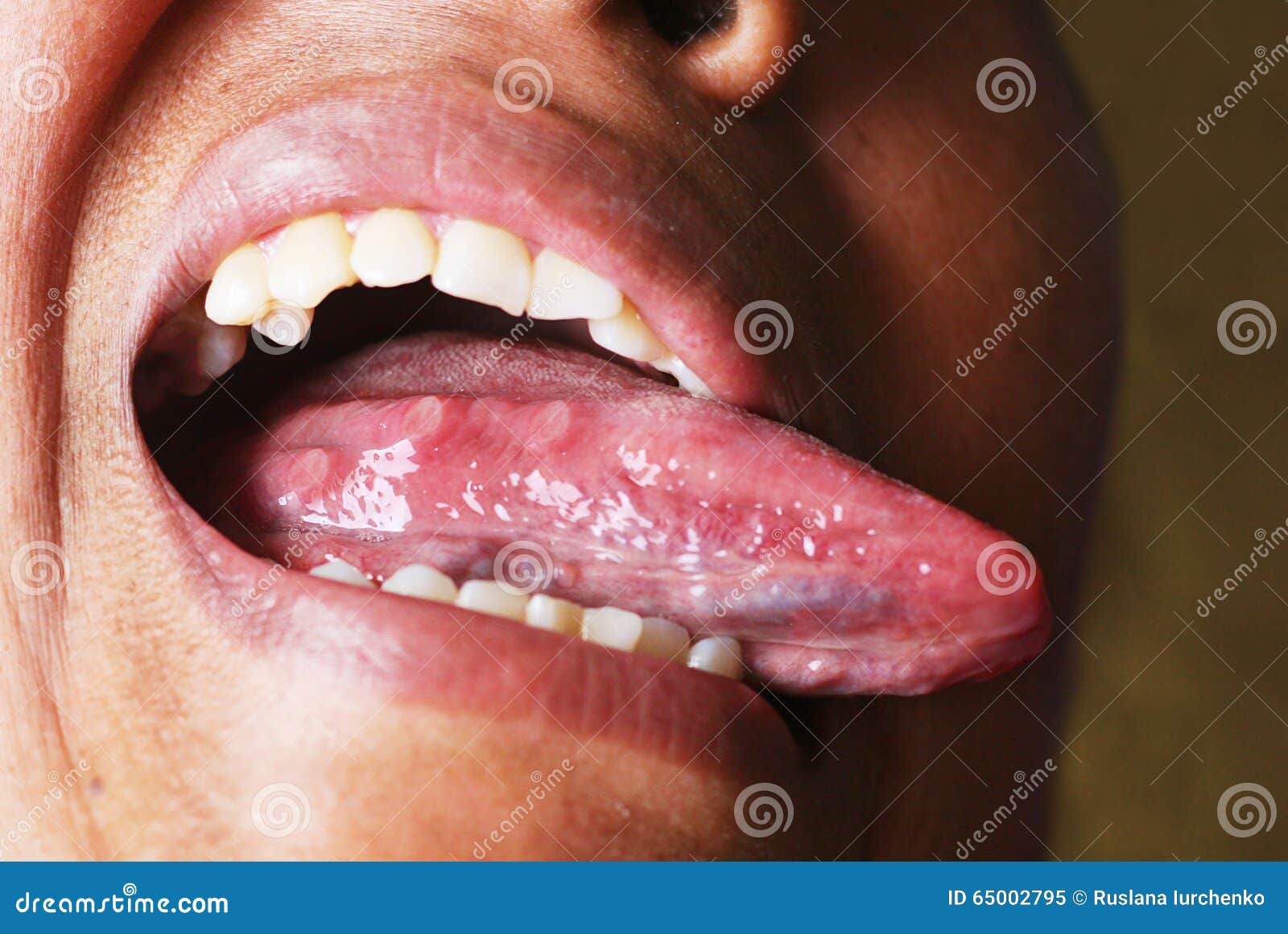 Acne on the tongue stock image. Image of nutrition, mouth 65002795