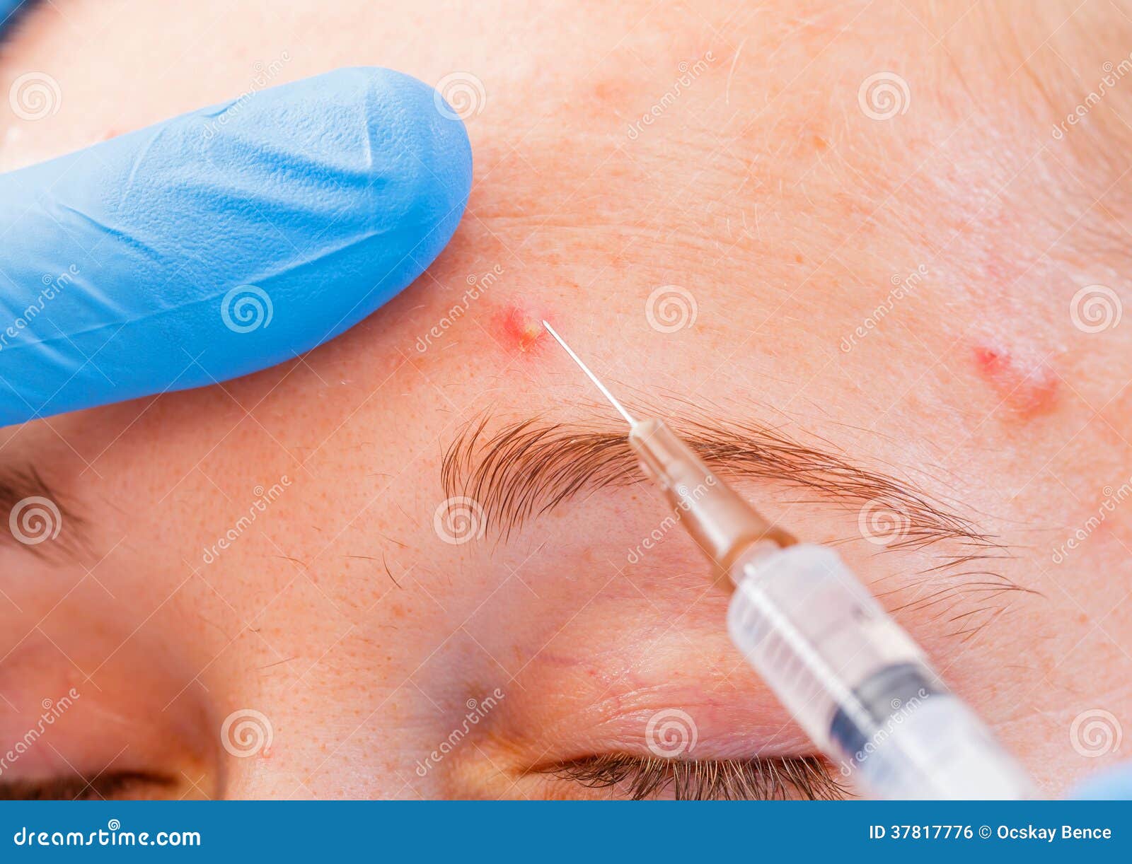 Acne Treatment With Zinc Ointment. The Back Of A Woman. The Hands Of A Cosmetologist Smear Skin