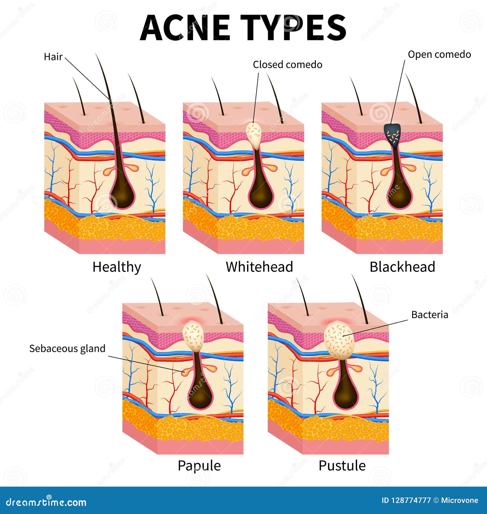 acne types. pimple skin diseases anatomy medical  diagram