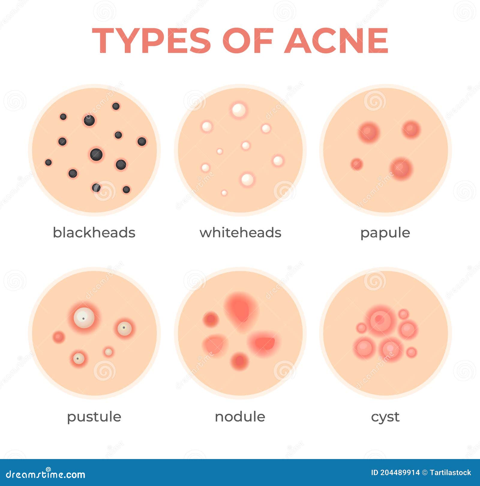 acne types. skin infection problem, pimples grade and type cyst, whitehead, blackheads, nodule and cystic. dermis pore