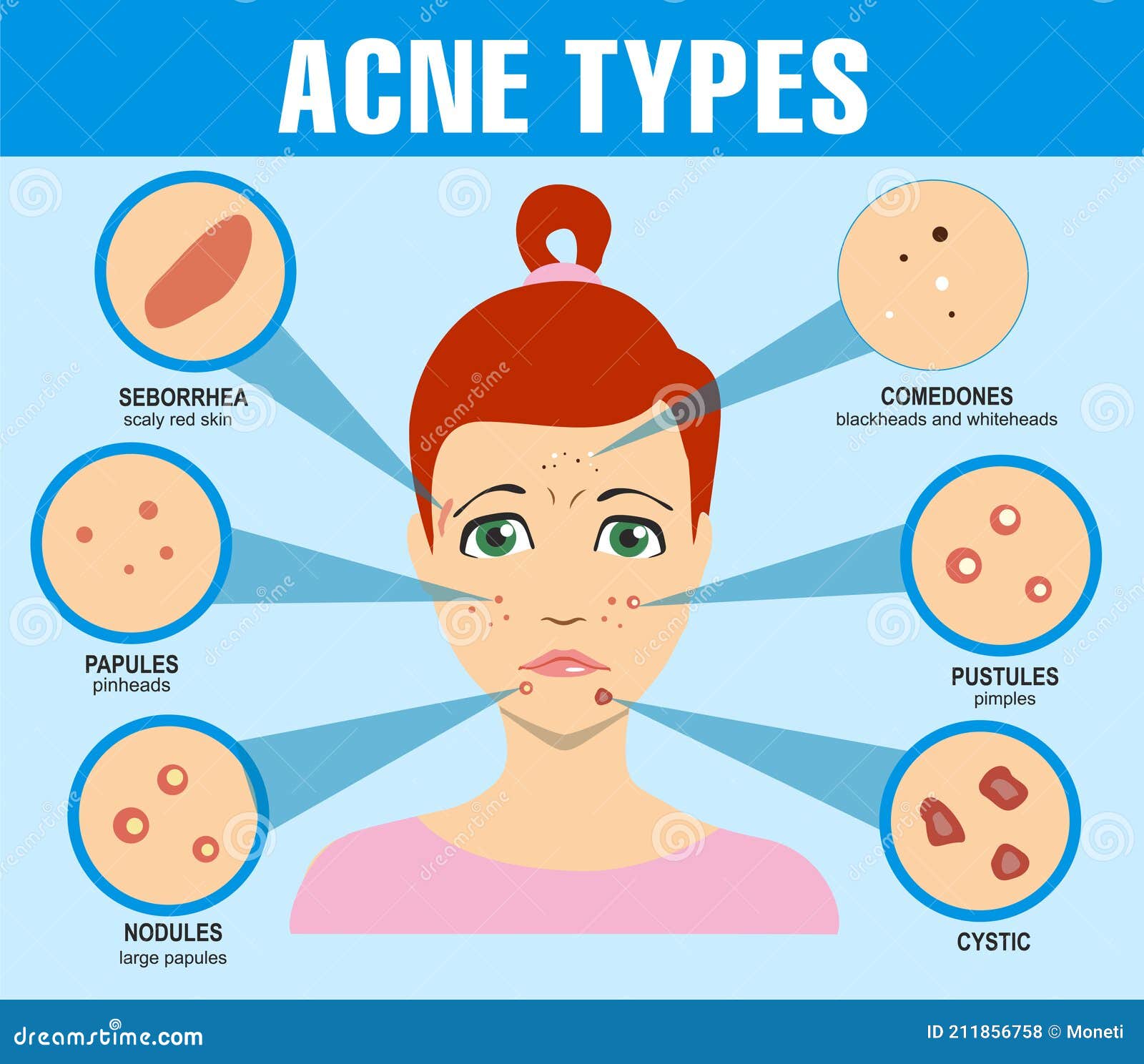 Types Of Acne On Face Types Of Acne On Face