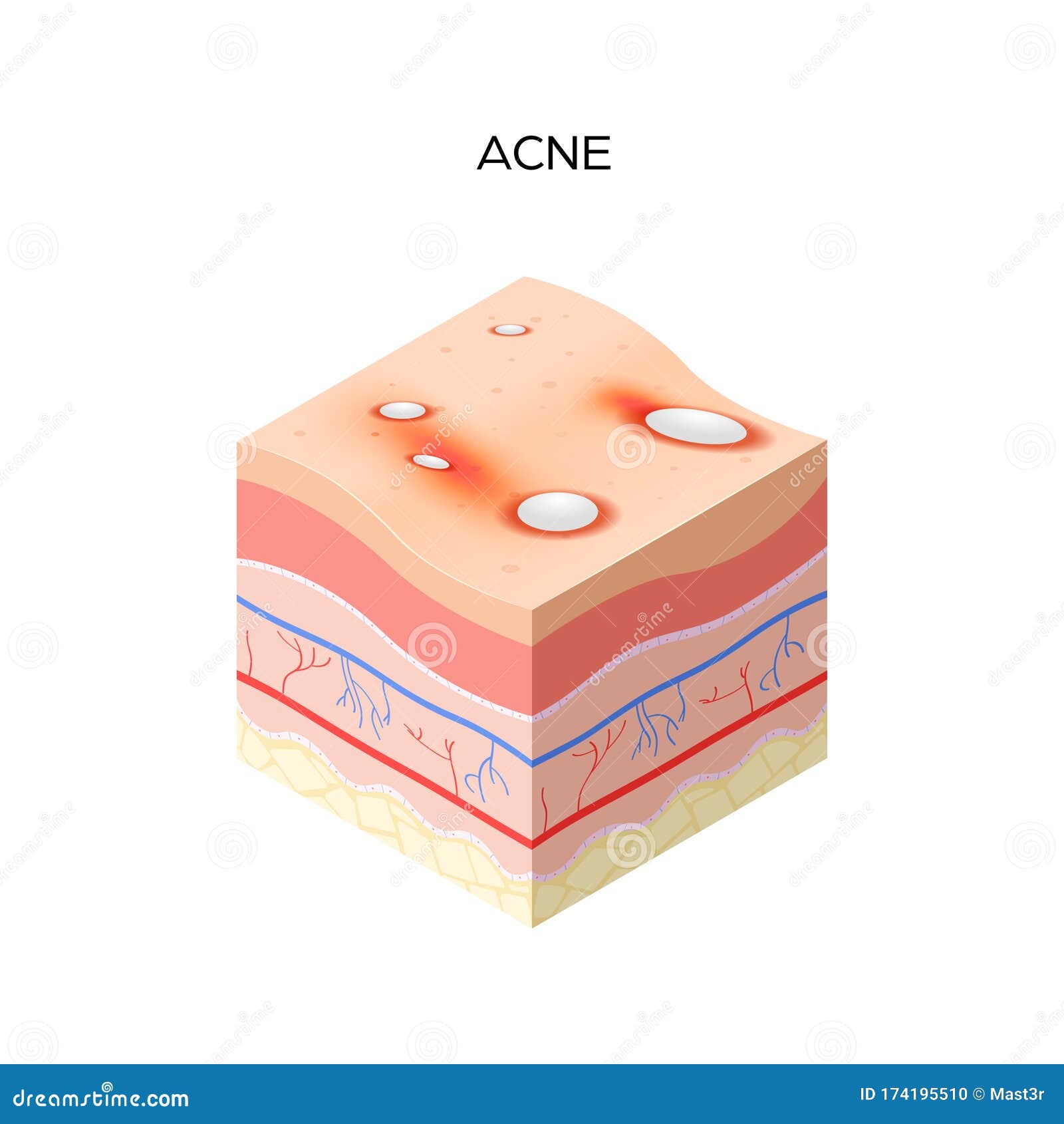 Acne Vulgaris or Pimple Cross-section of Human Skin Layers Structure ...