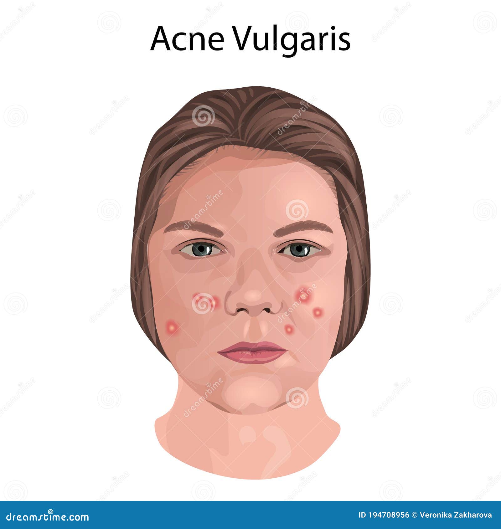 faces with acne vulgaris