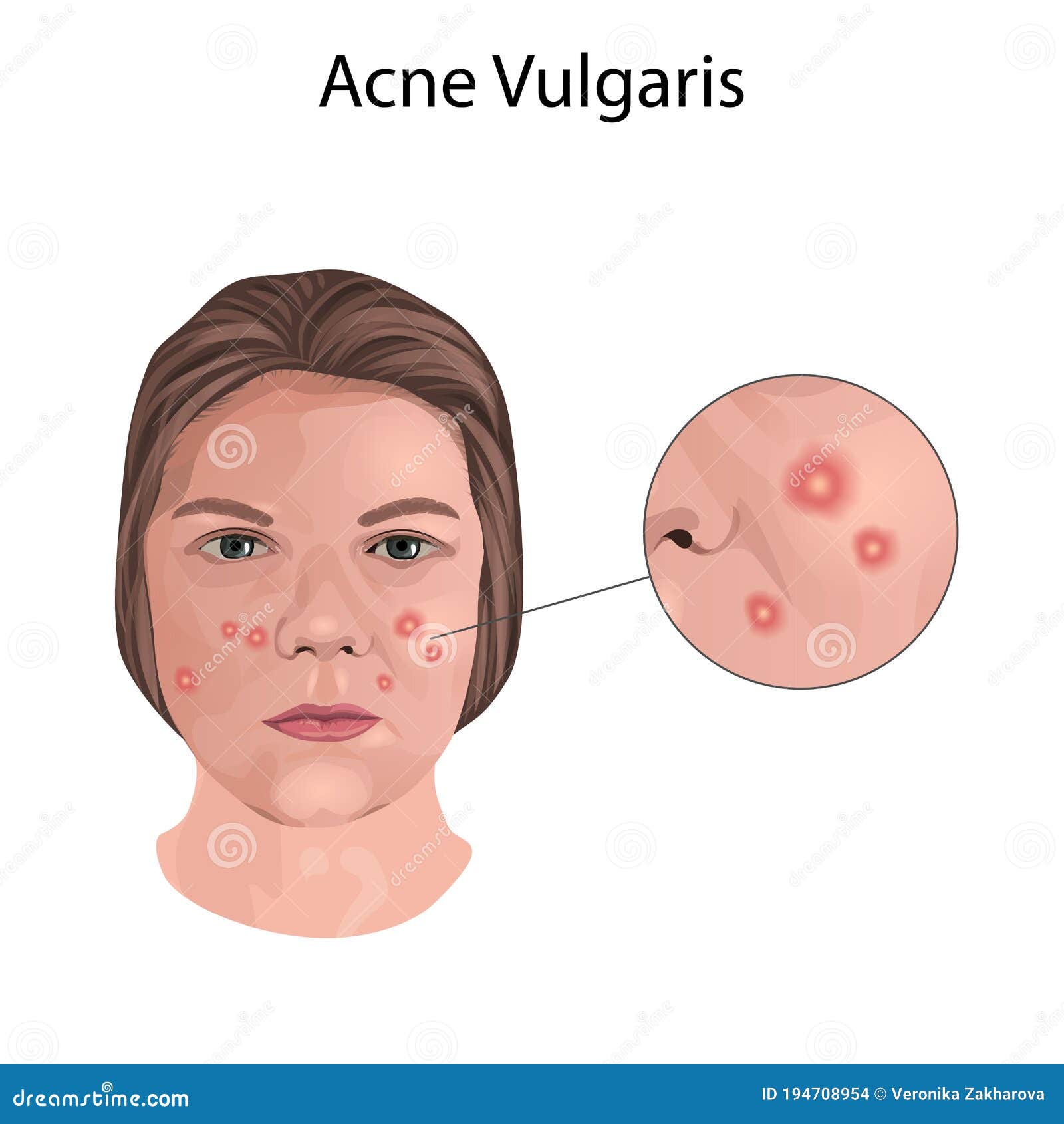 faces with acne vulgaris