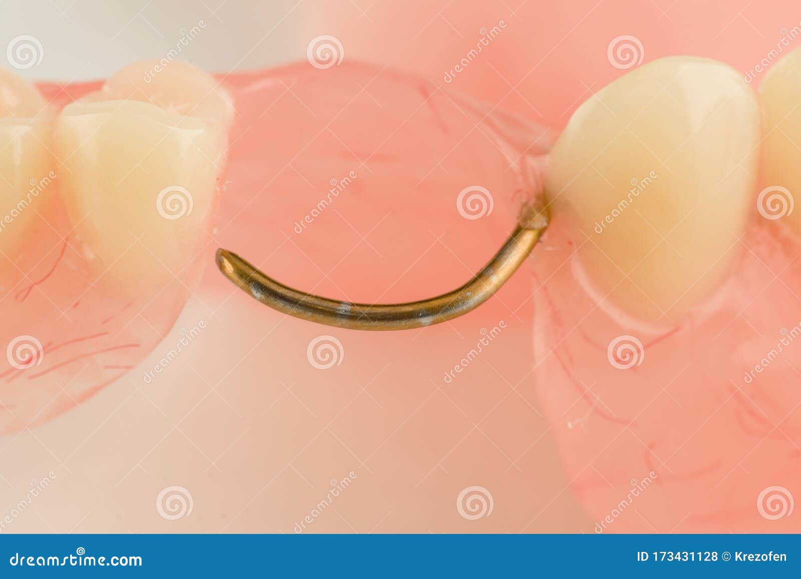 Acrylic dental prosthesis stock photo. Image of removable 173431128