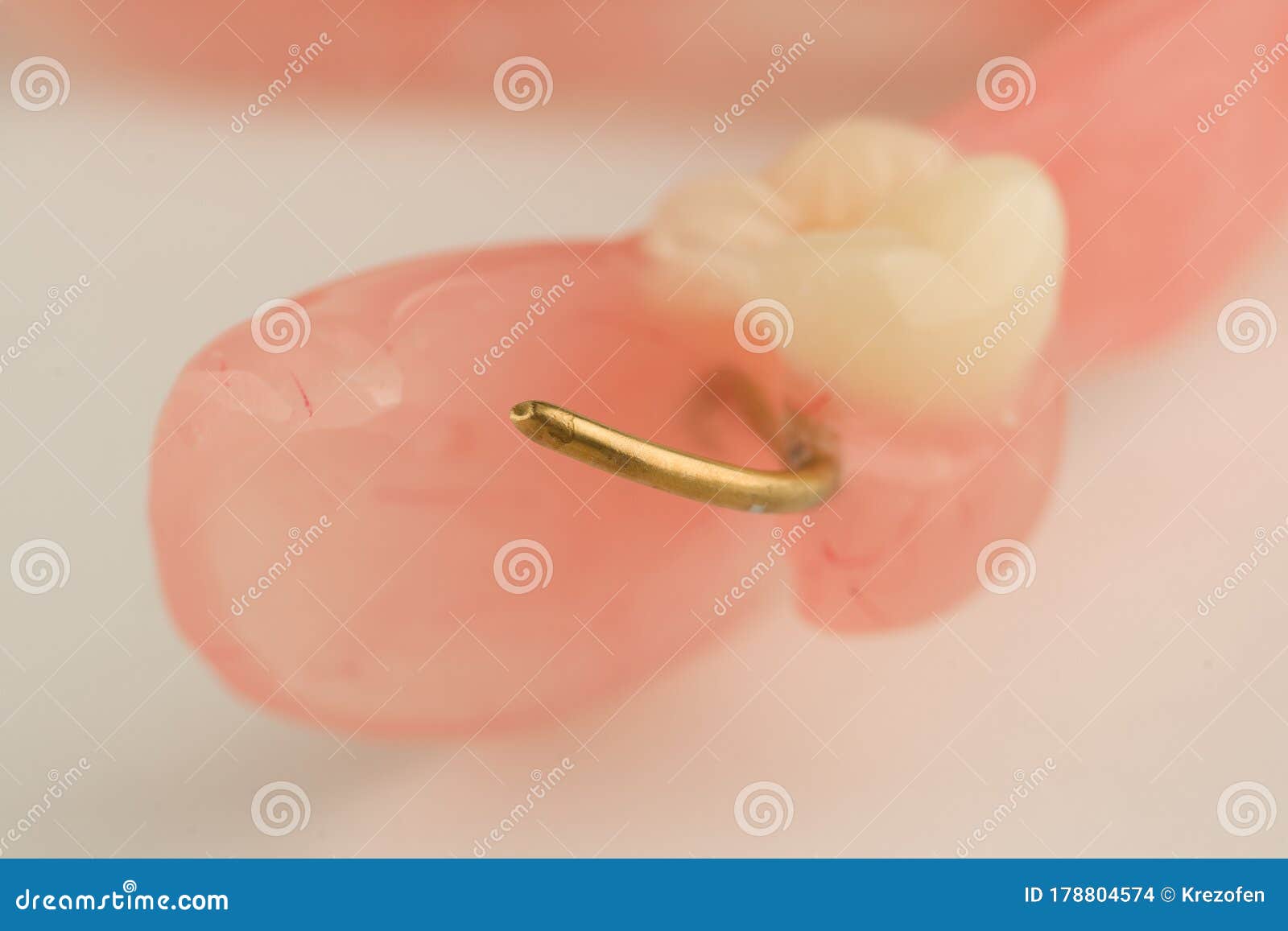 Acrylic dental prosthesis stock photo. Image of plastic 178804574