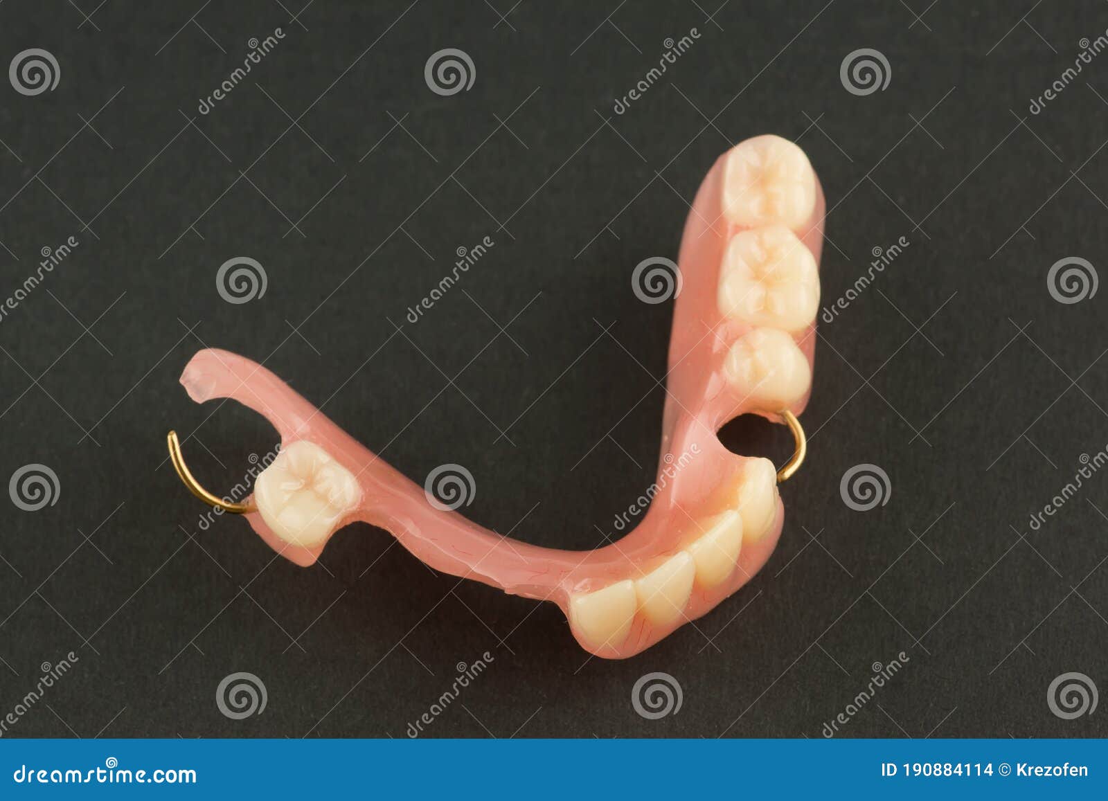 Acrylic Dental Prosthesis with Metal Retaining Elements Stock Photo