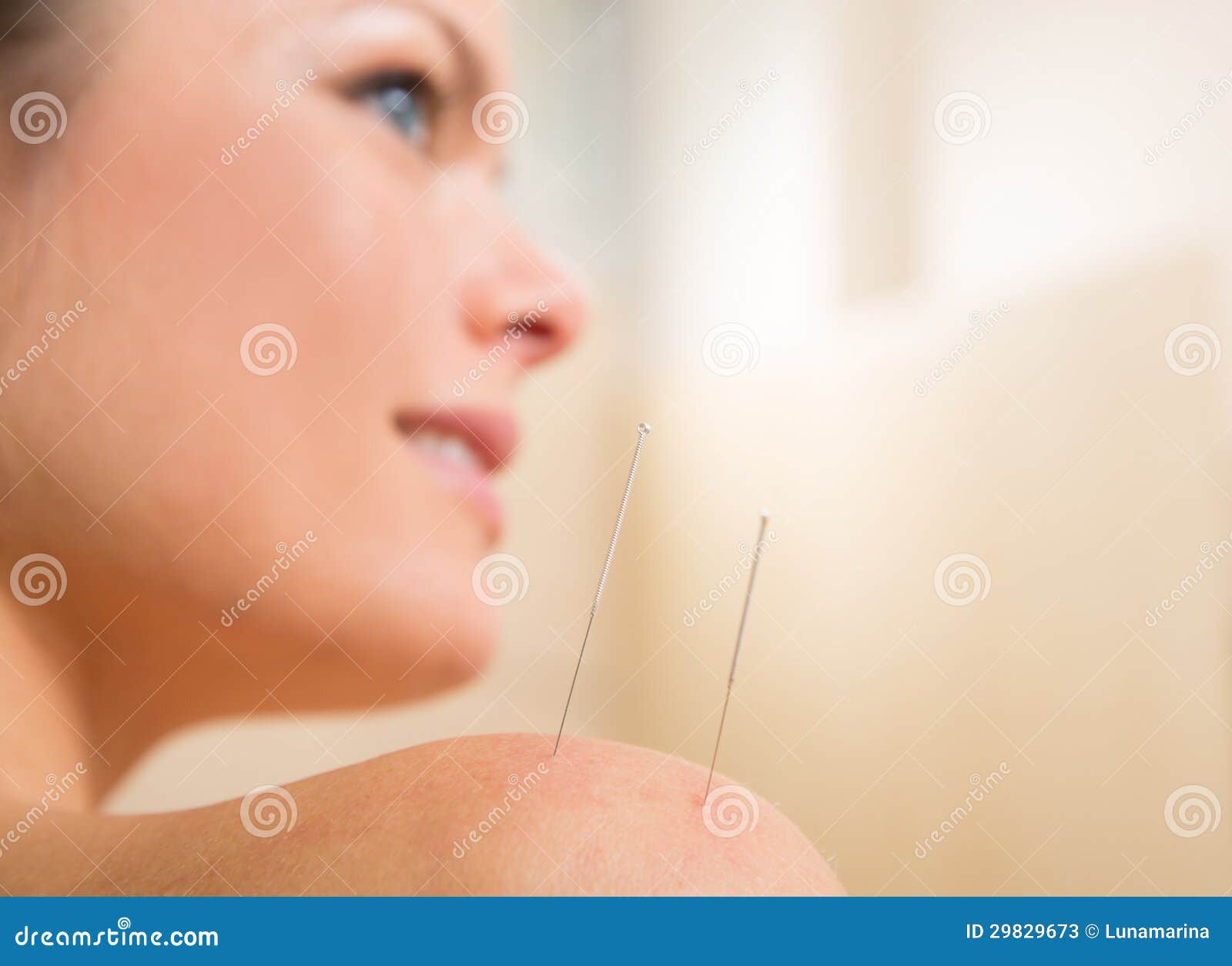 Acupuncture Needle Pricking on Woman Shoulder Stock Image - Image of