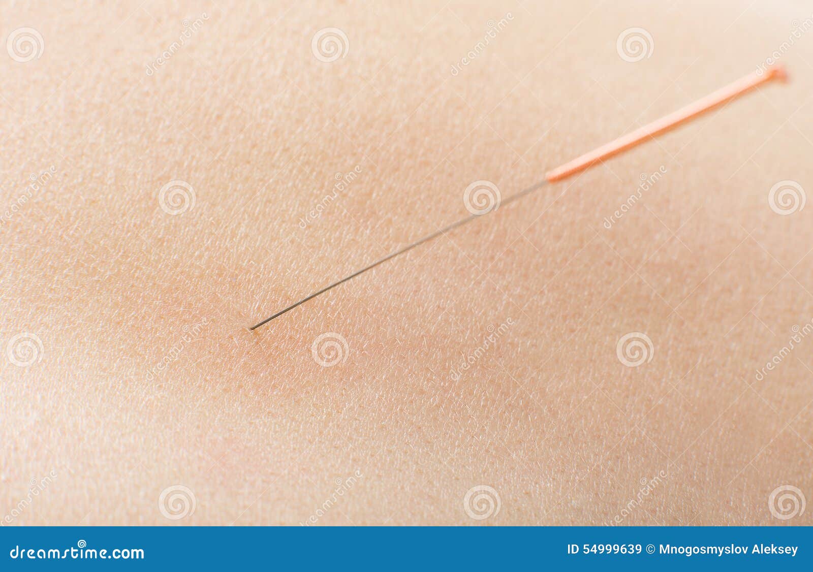 Acupuncture stock image. Image of skin, needle, medical 54999639