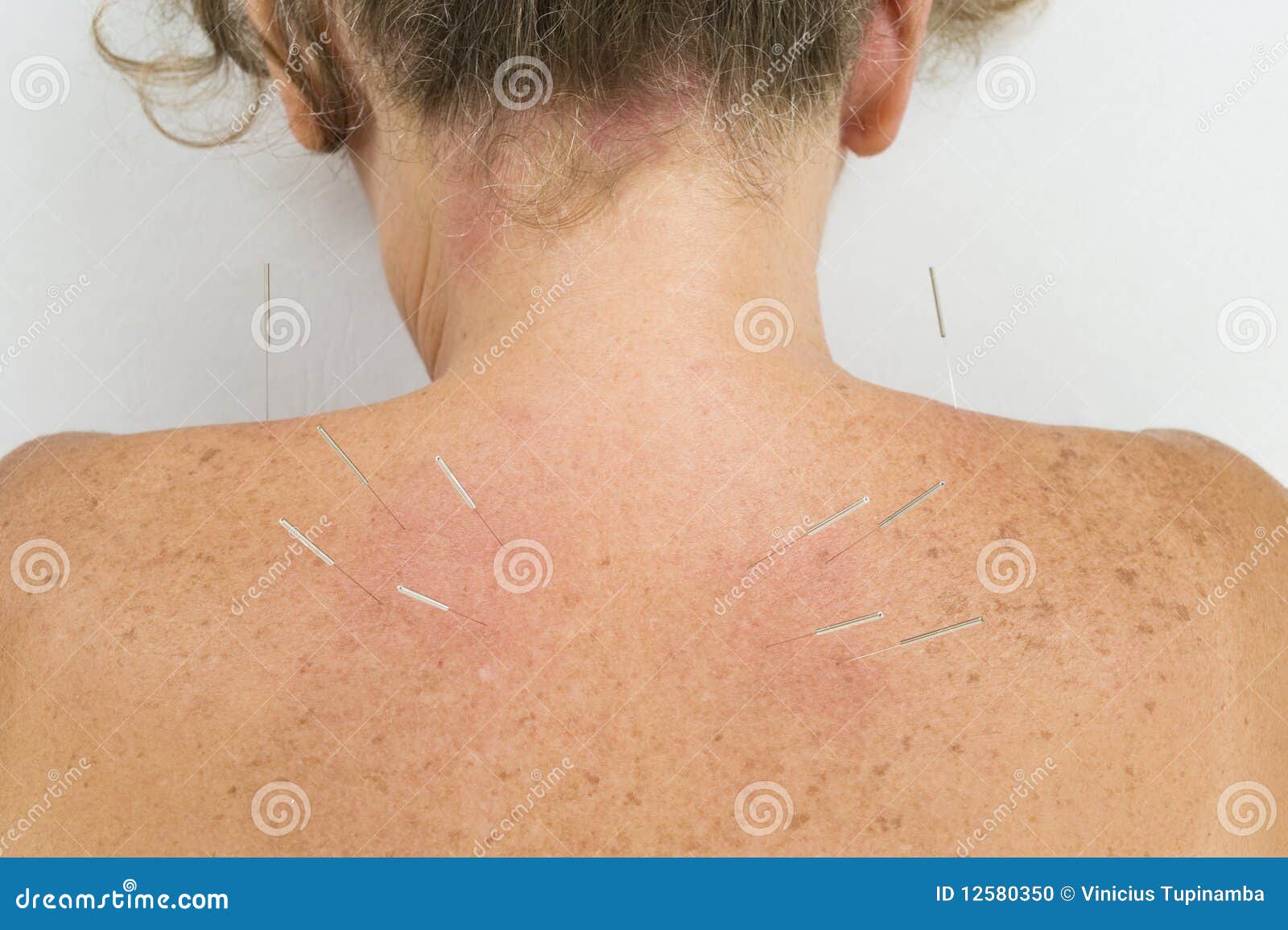 Acupuncture Needles in Backs Stock Photo Image of white, wellness