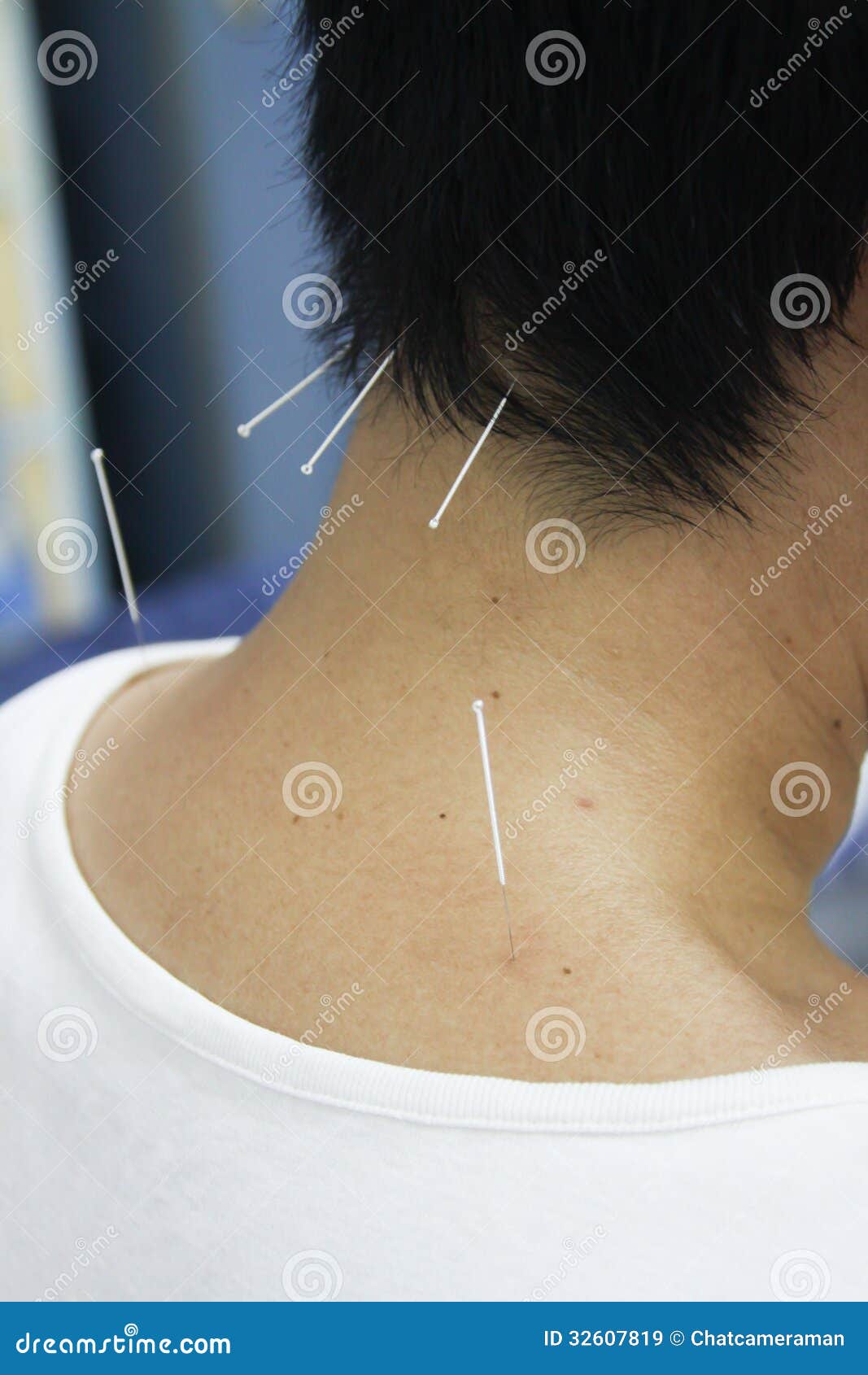 Acupuncture stock image. Image of alternative, person 32607819