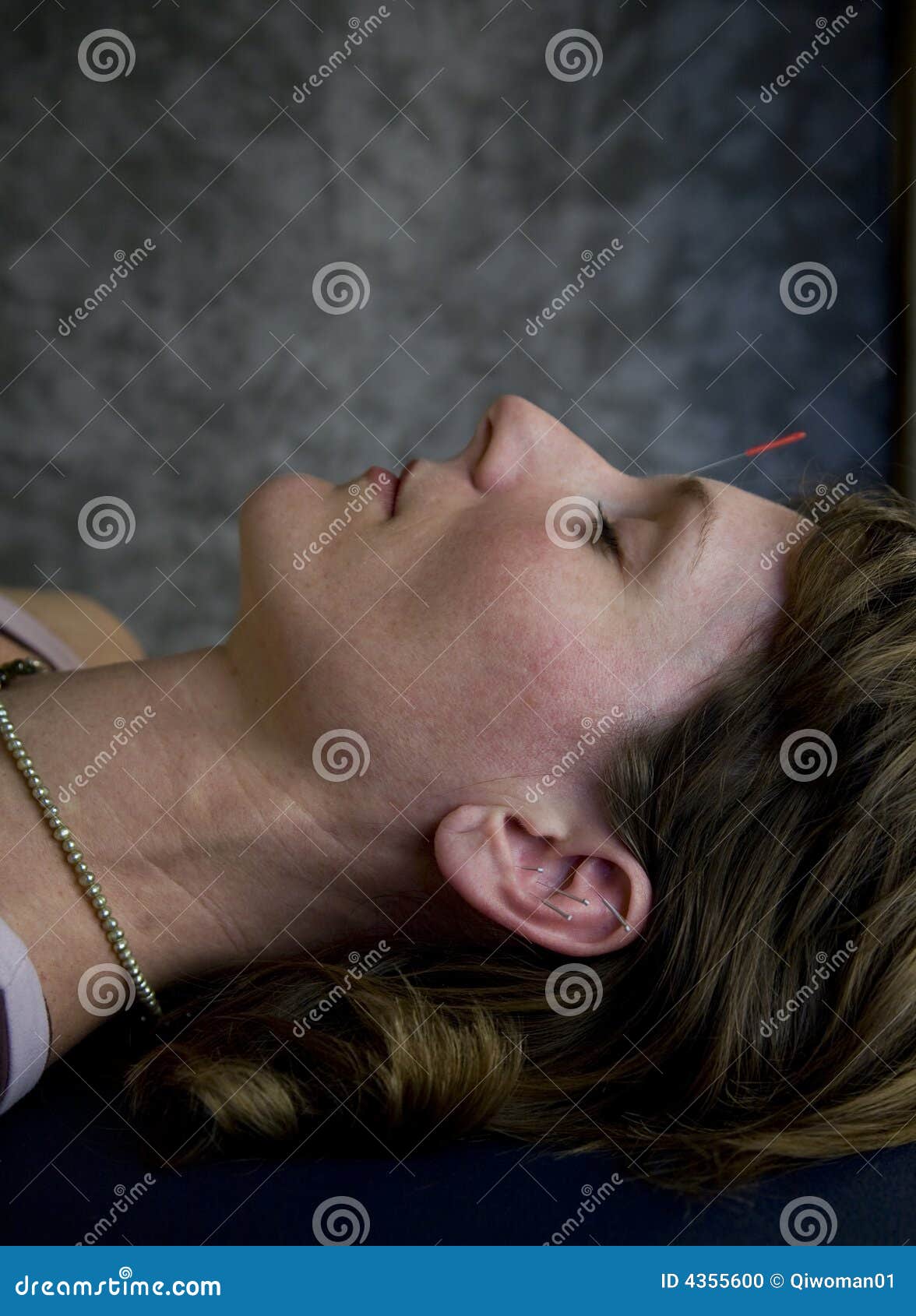 Acupuncture Treatment stock photo. Image of acupuncture 4355600