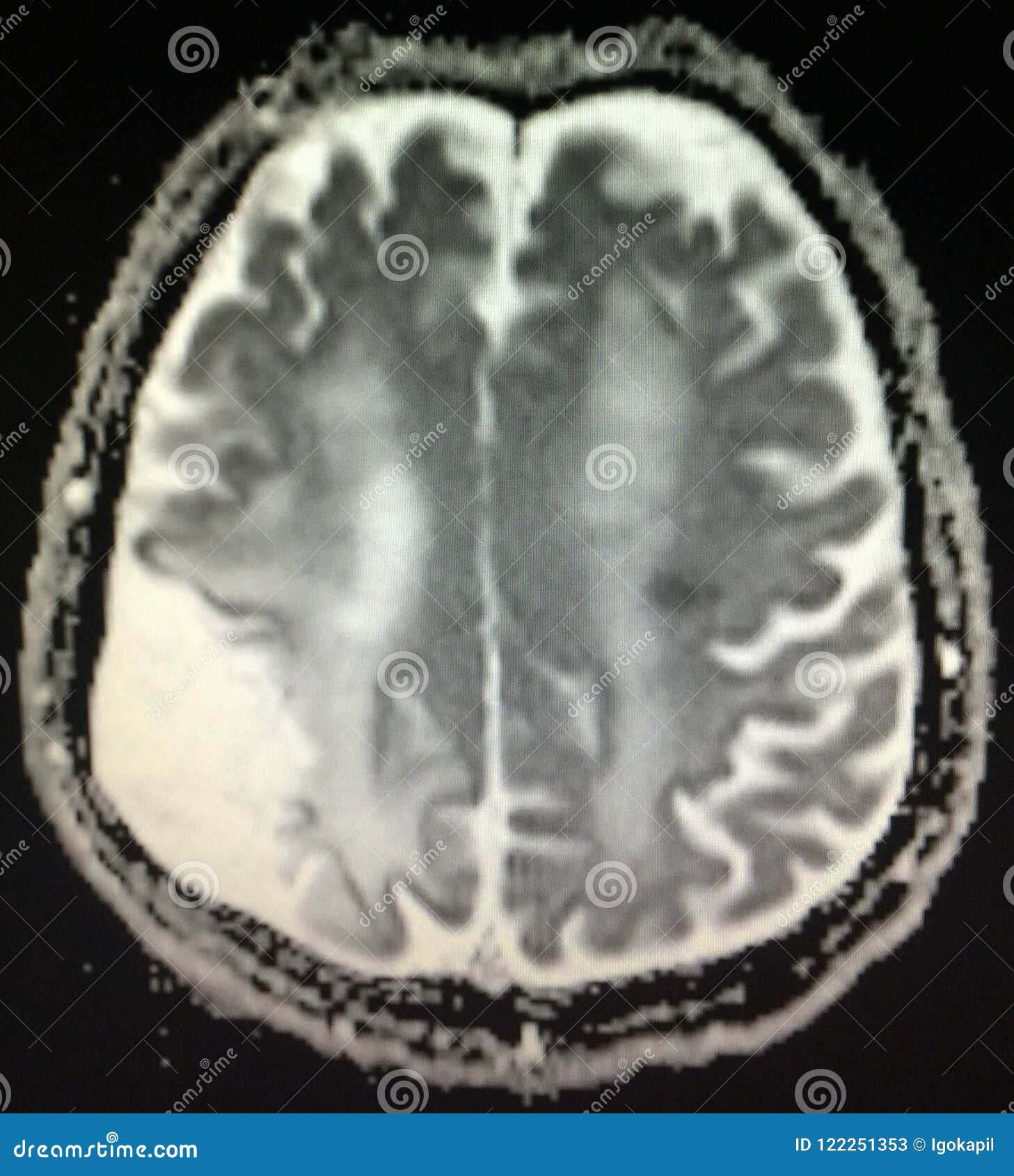 Acute Infarction Brain Mri Examination Stroke Stock Image Image Of