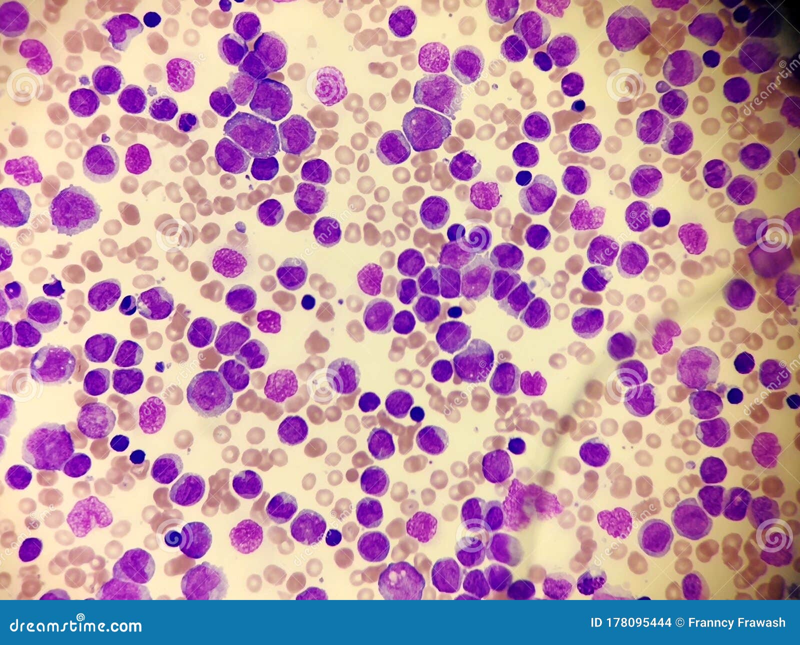 acute leukemia in a blood smear. hematology.