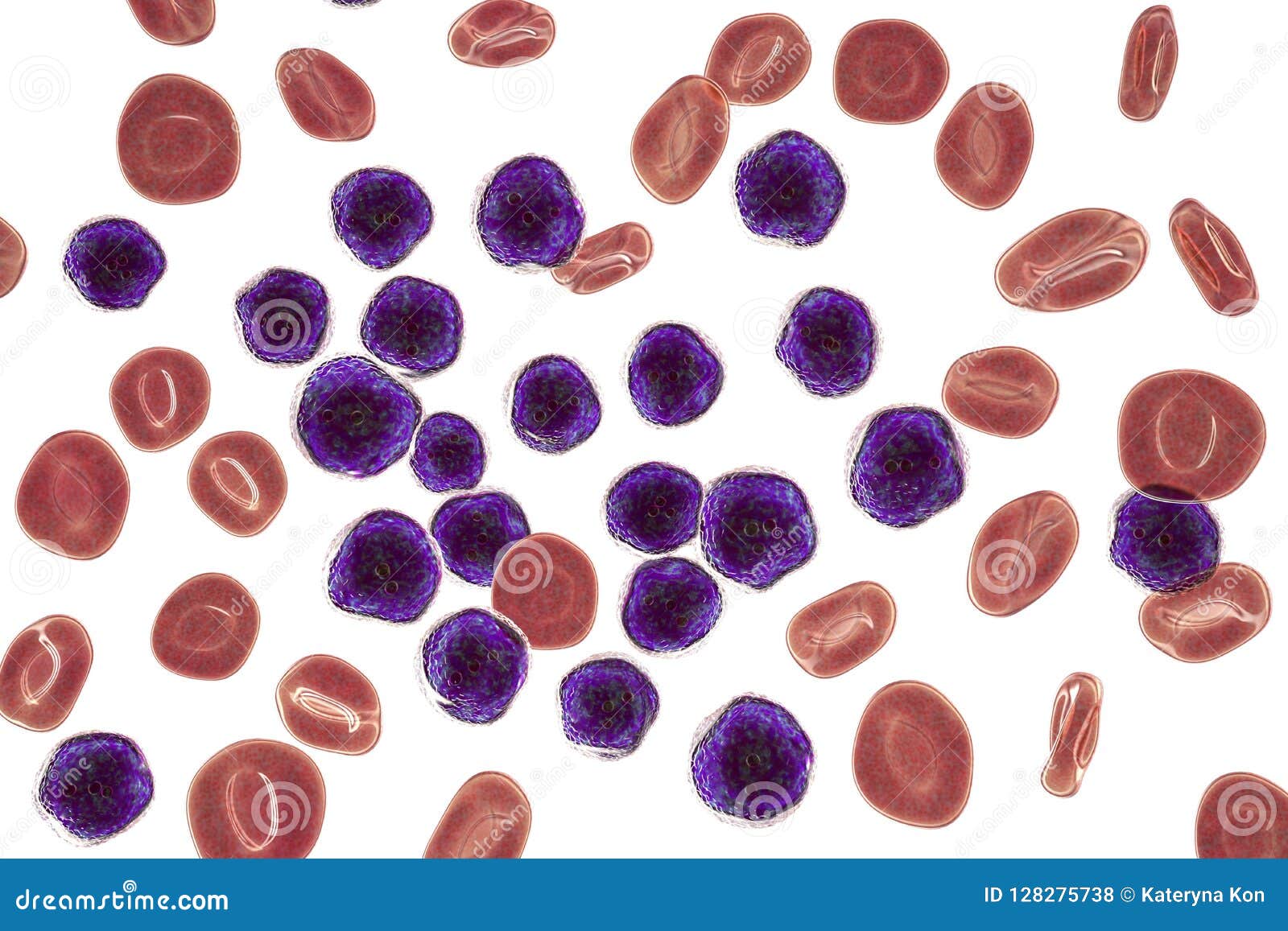 Acute Lymphoblastic Leukemia, Bone Marrow Smear Stock Illustration