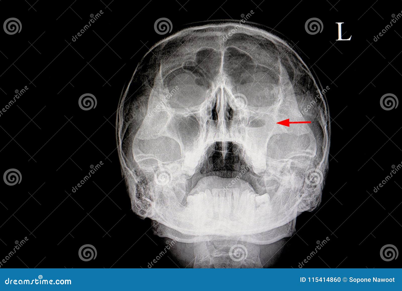 Radiologic Imaging In The Management Of Sinusitis American