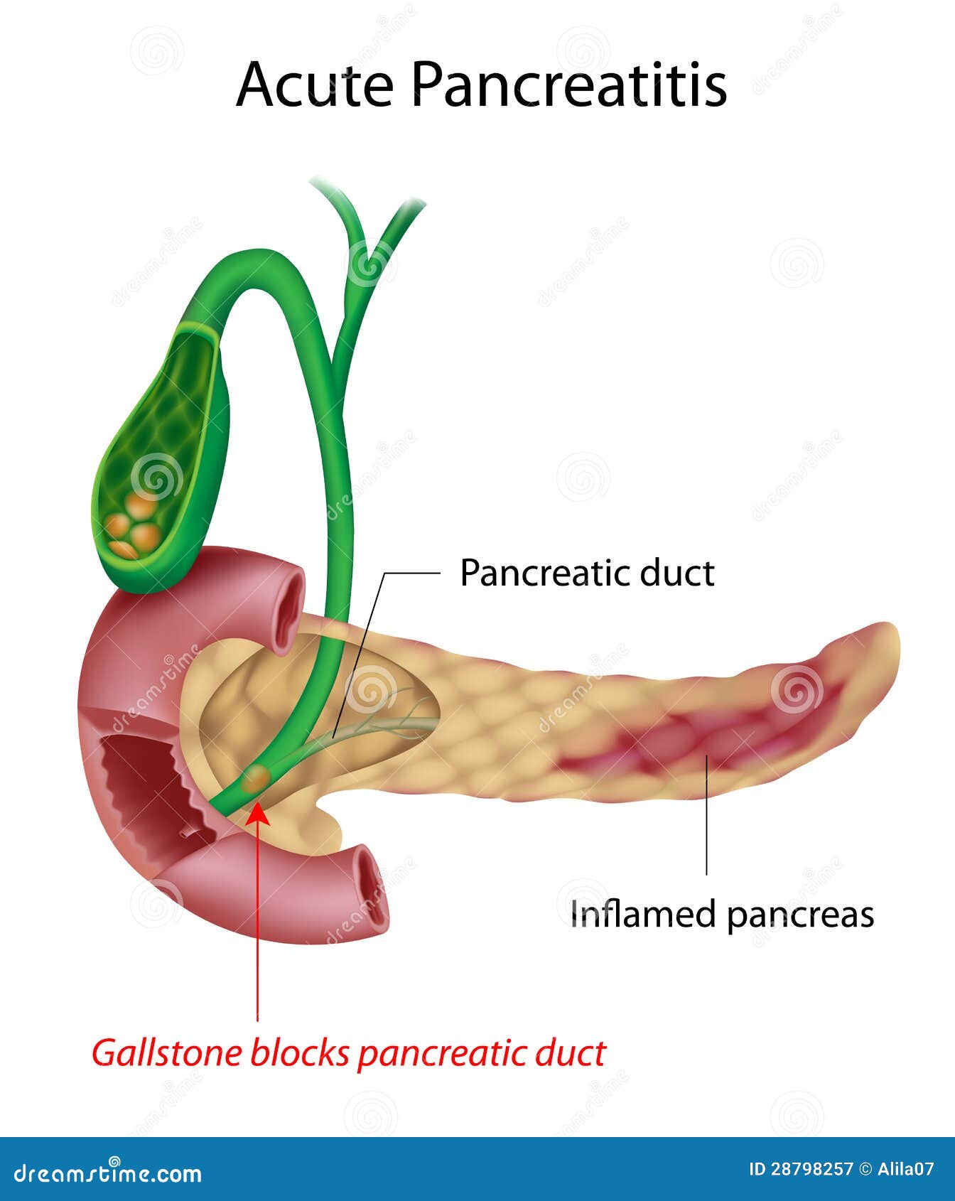 Acute Pancreatitis stock vector. Illustration of hepatic - 28798257