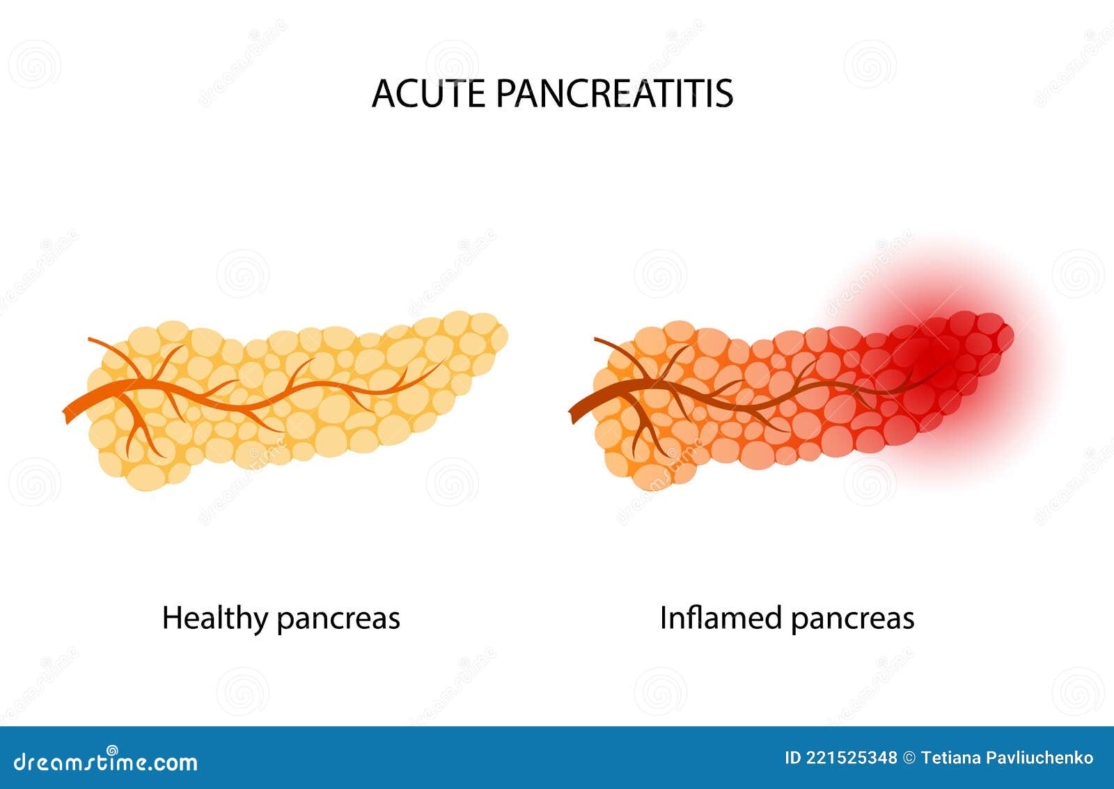 Cholecystitis As Inflamed Gallbladder Compared With Healthy Outline cholecystitis-as-inflamed-gallbladder-compared-with-healthy-outline