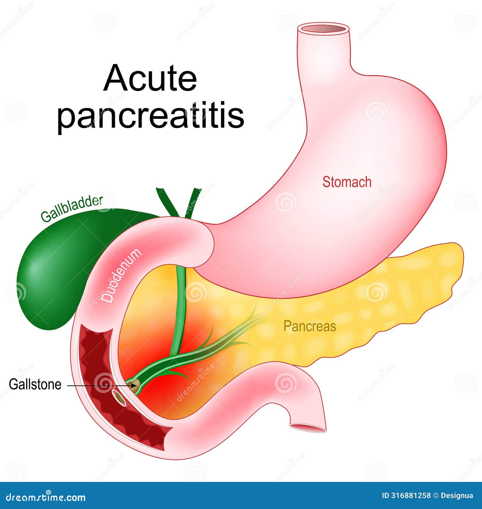 acute pancreatitis. pancreas inflammation