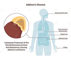 Addison Disease