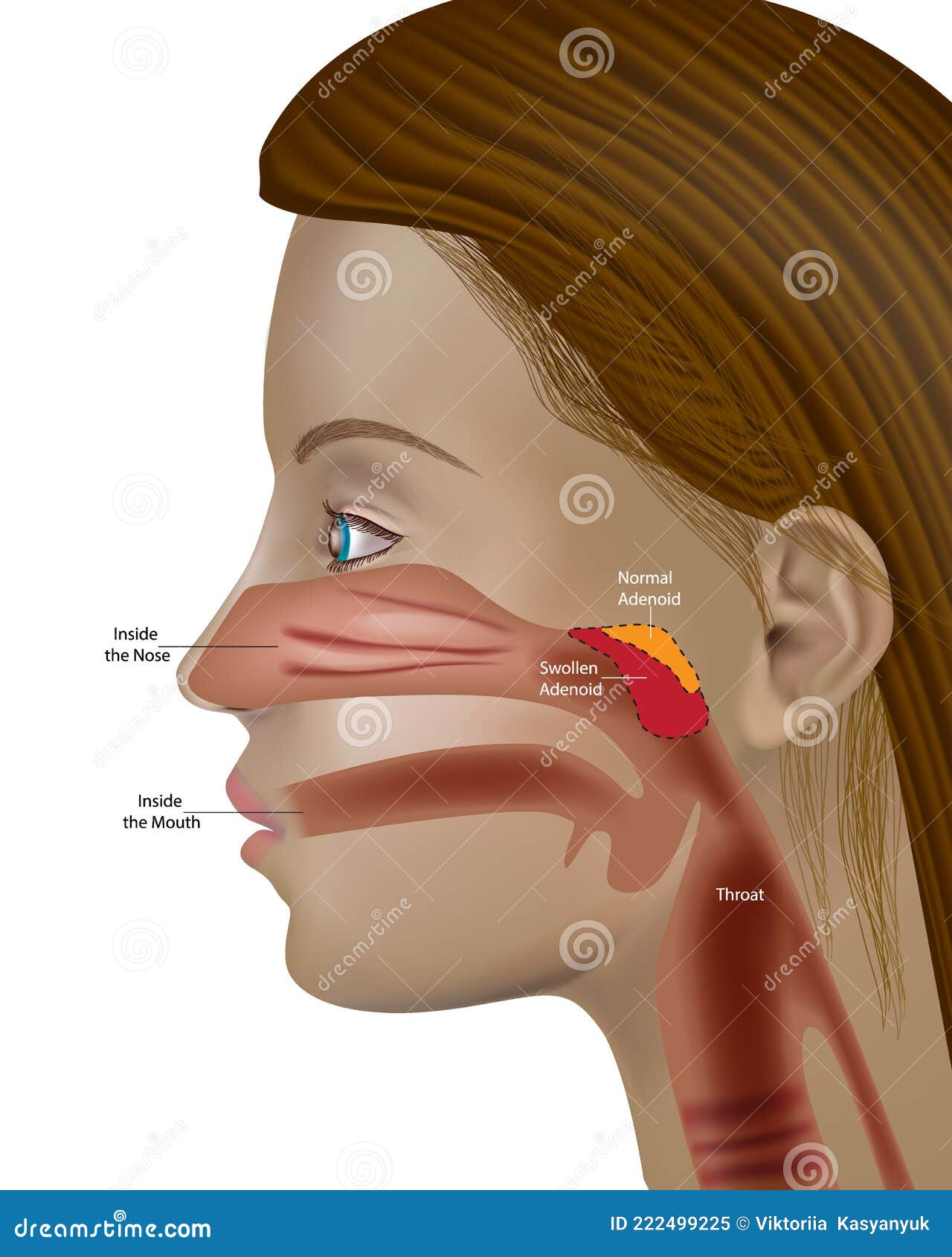 adenoids, pharyngeal tonsil or nasopharyngeal tonsil otolaryngology adenoid hypertrophy