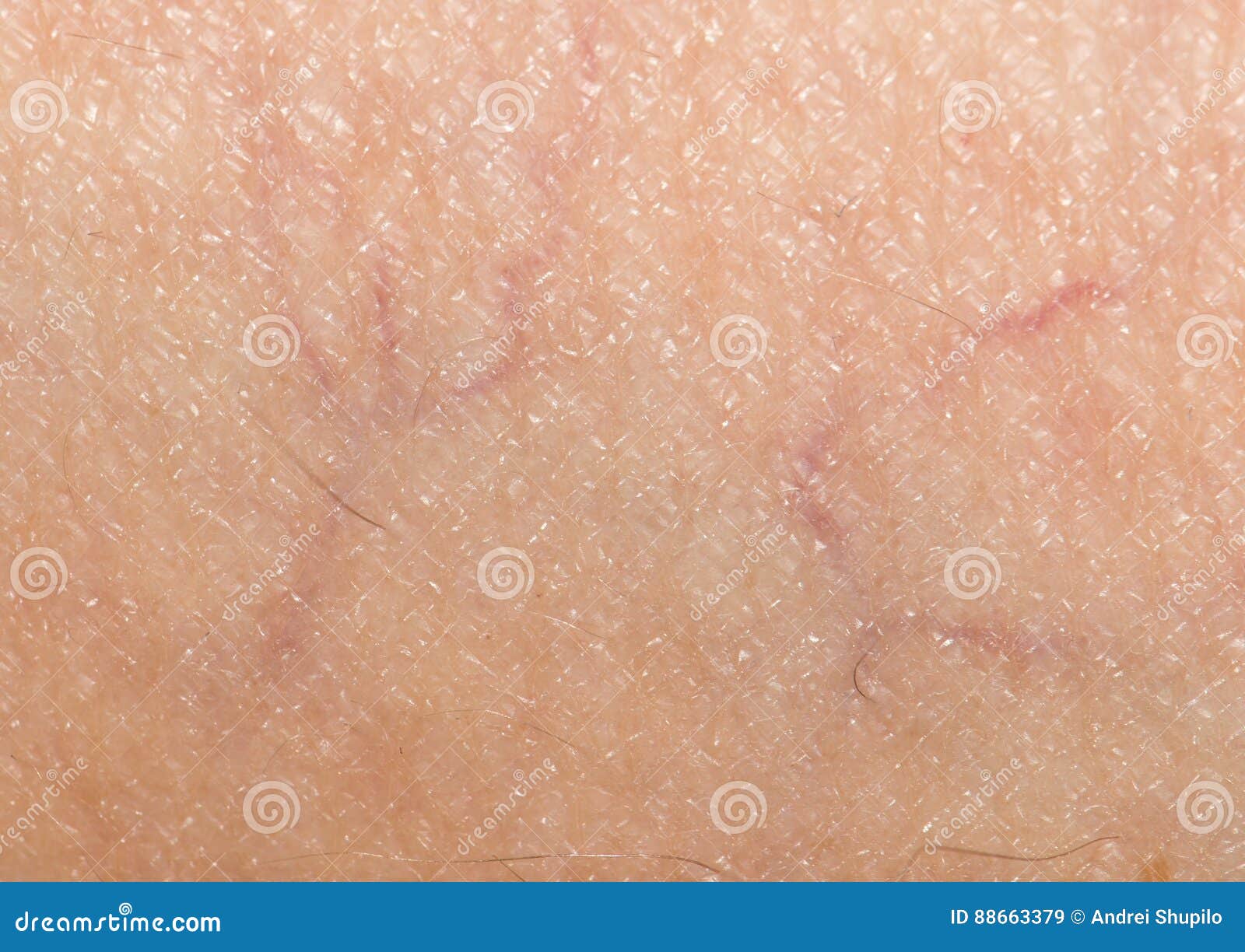 Adern Auf Der Haut Abschluß Stockbild Bild von obacht, gefahr 88663379