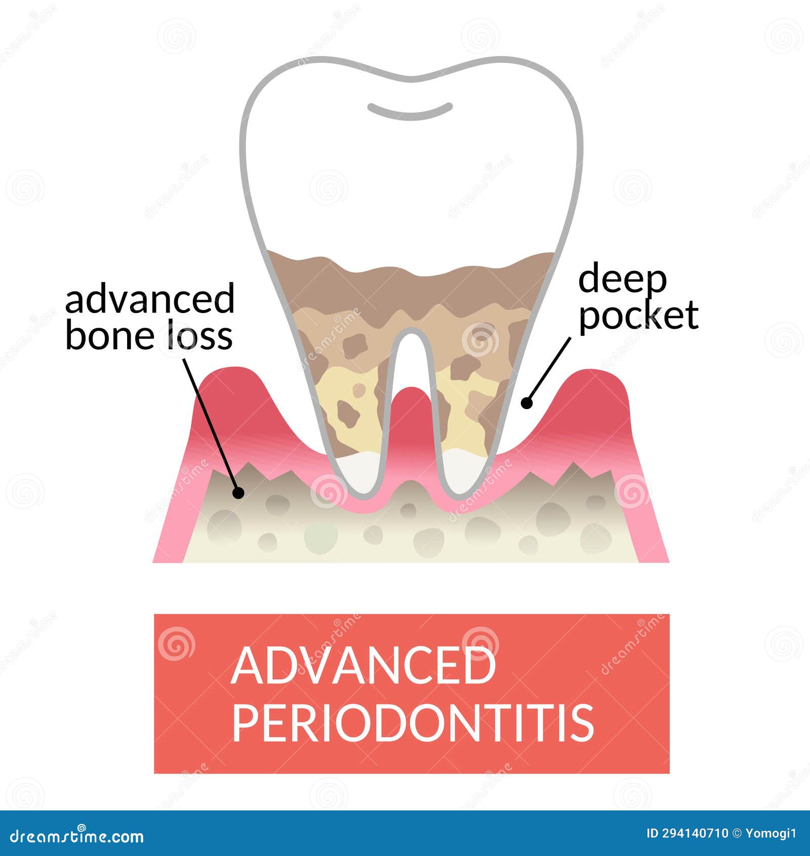 Periodontal Pocket and Bone Destruction. Destroyed Bone Cause Teeth To