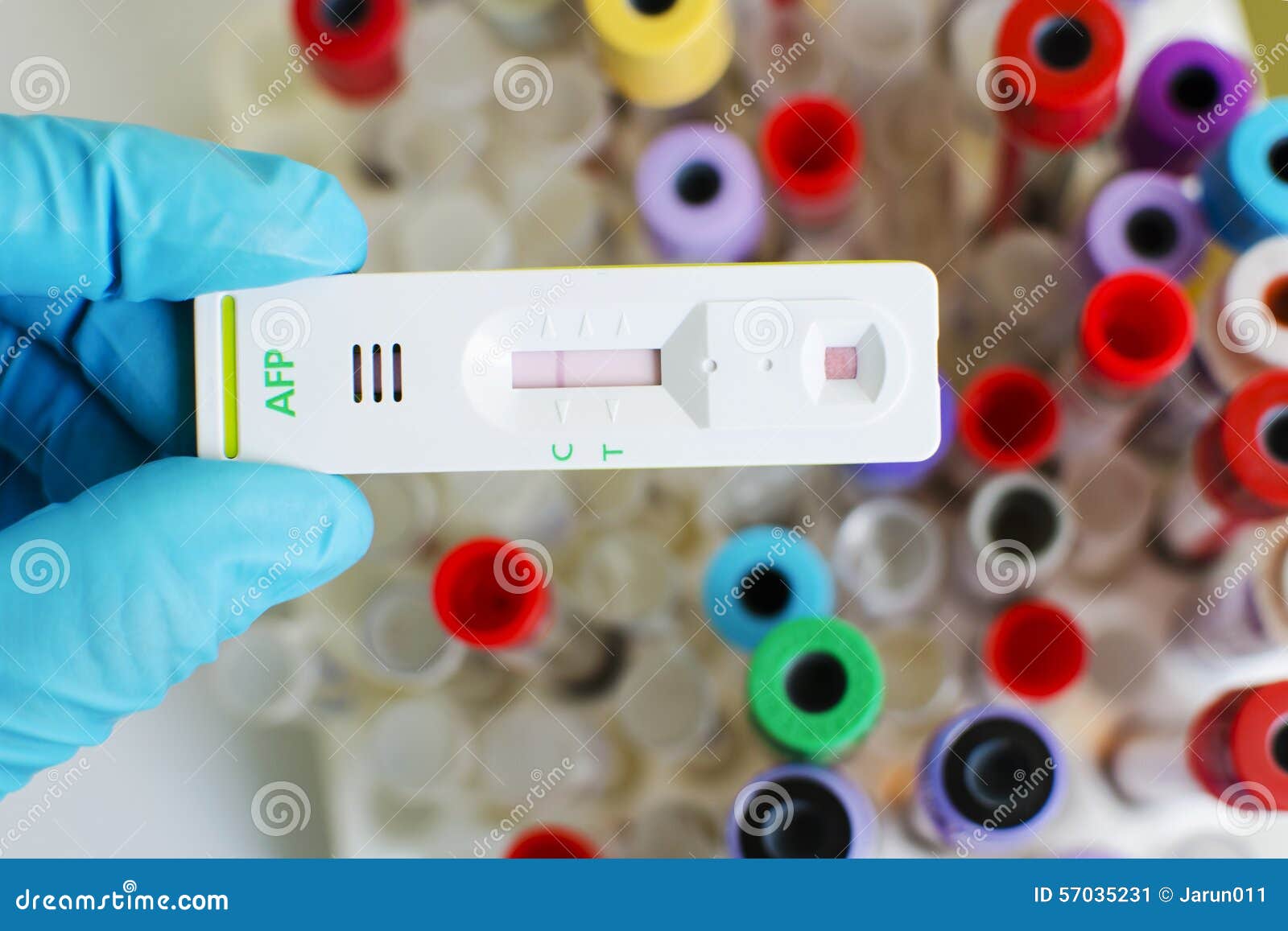 afp test done second sequential screening