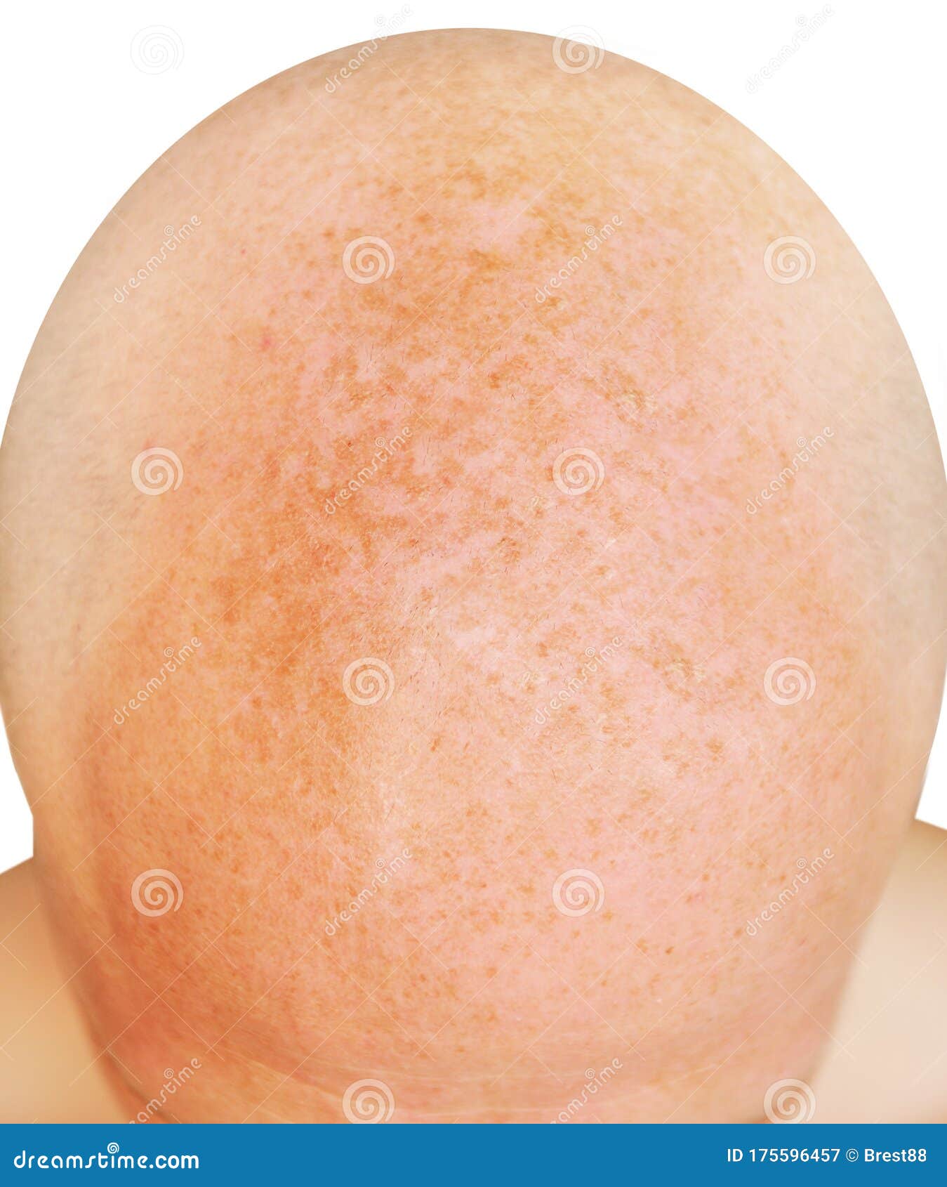 Age Spots On The Bald Head Of A Man From Sunburn Stock Image Image Of