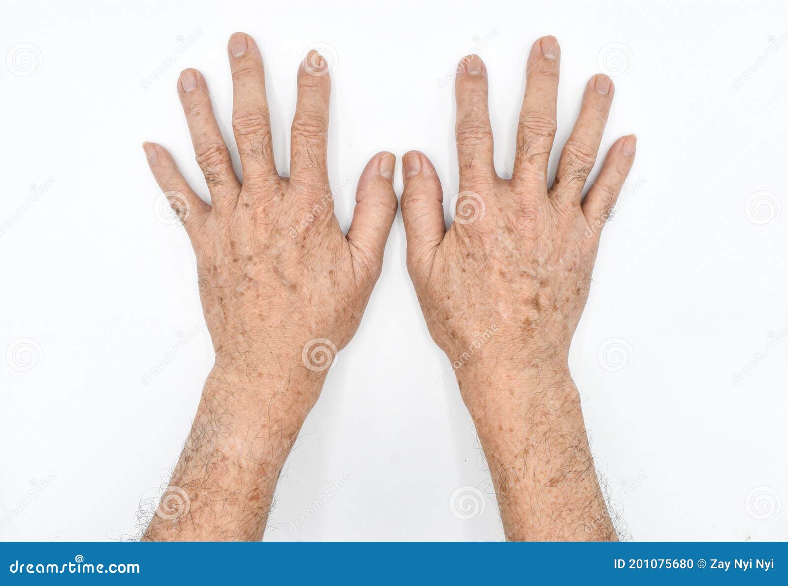 age spots on hands of asian elder man. they are brown, gray, or black spots and also called liver spots, senile lentigo, solar