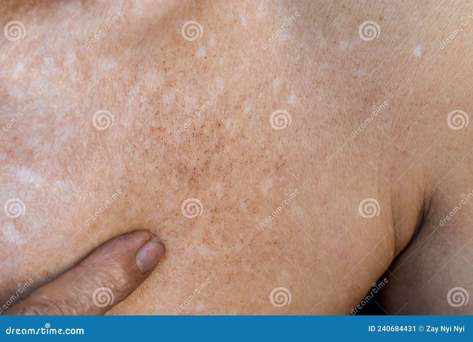 Age Spots (Solar Lentigo, Liver Spots) - Harvard Health