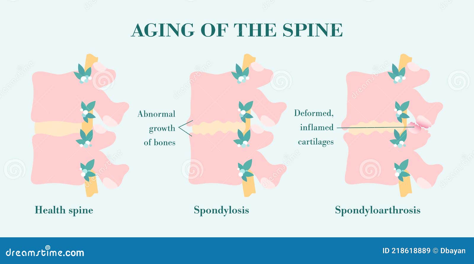 aging and degeneration of spine columns, patient-friendly diagram