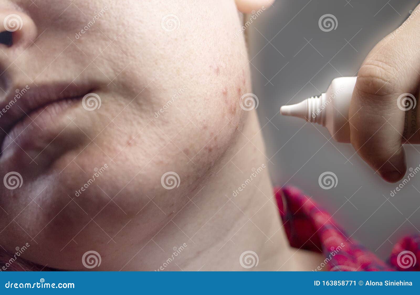 Akne Im Kinn Demodikose Zecken Auf Der Haut Eines Madchens Patienten Bei Der Ernennung Eines Dermatologen Problem Haut Und Stockbild Bild Von Ernennung Problem