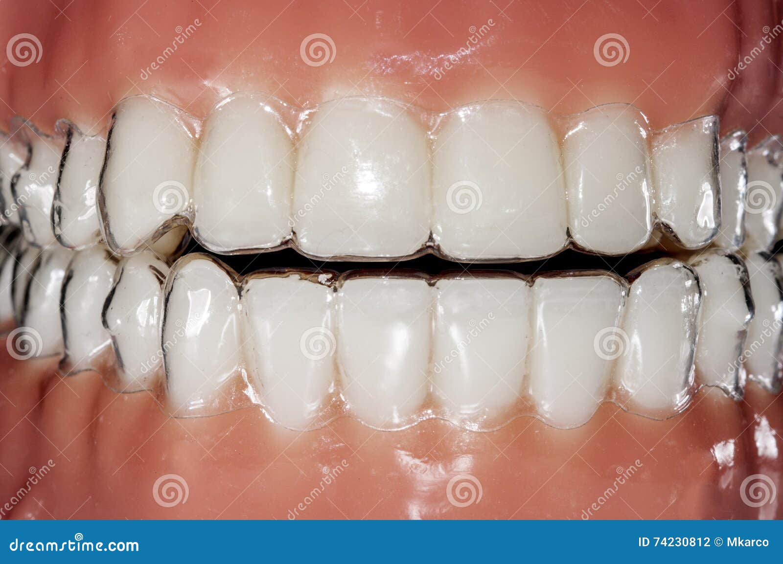 Alinhador Invisível Ortodôntico Para O Tratamento Dos Dentes Foto de Stock  - Imagem de inovativo, implante: 74230812