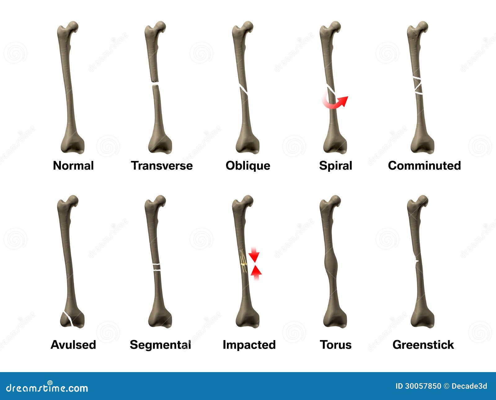 all types of bone fractures