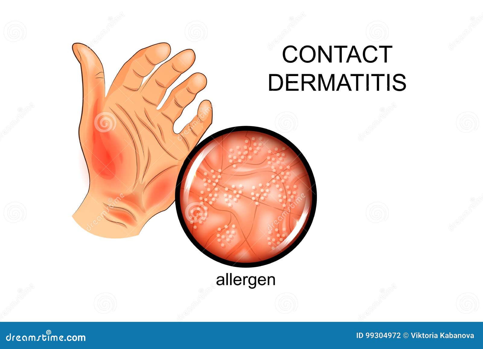 Allergen on the Skin. Allergy, Dermatology Stock Vector Illustration