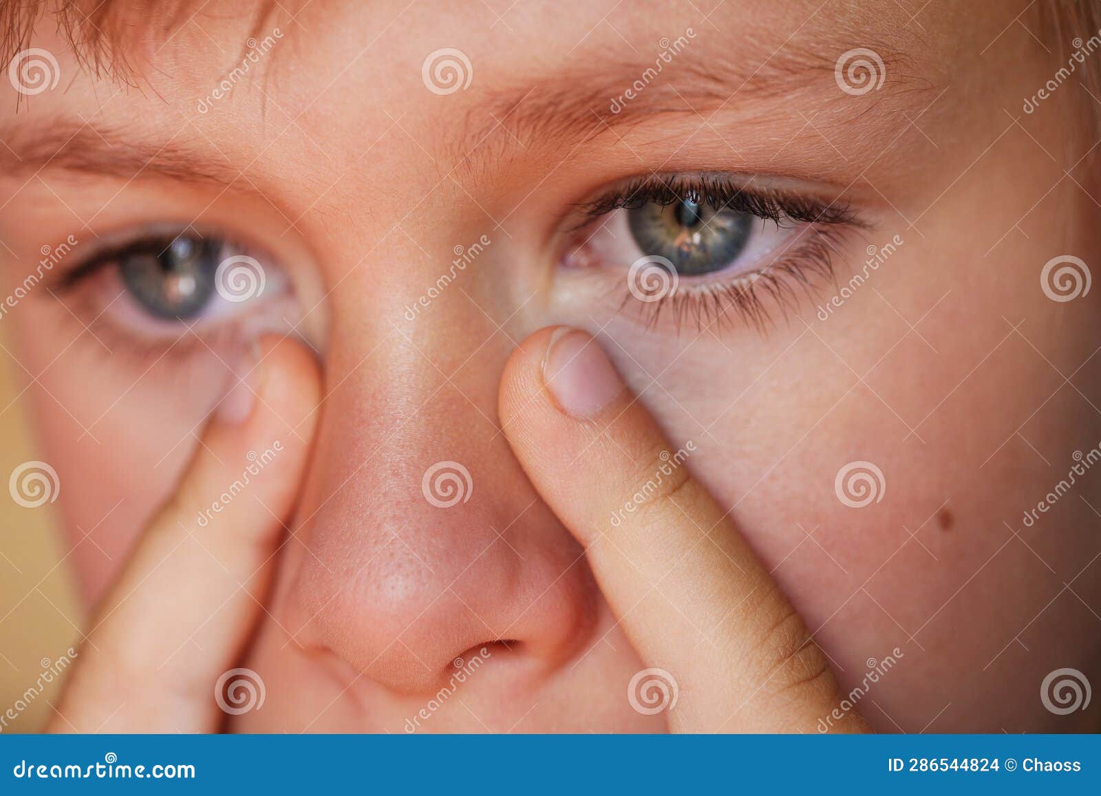 Allergic Boy Scratching His Eyes Closeup View Stock Photo Image of