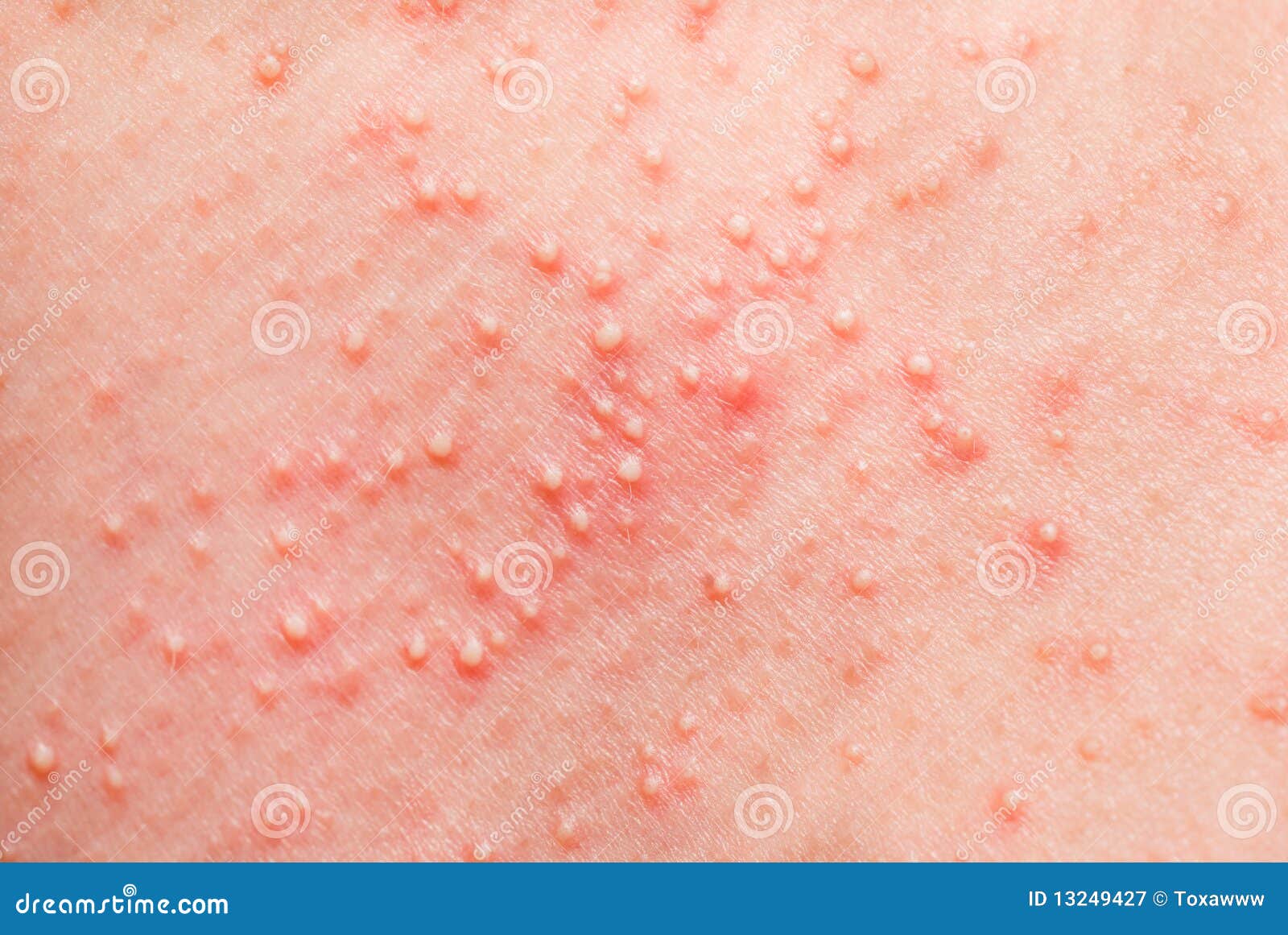 Pictures of Allergic Skin Diseases and Problems - Eczema