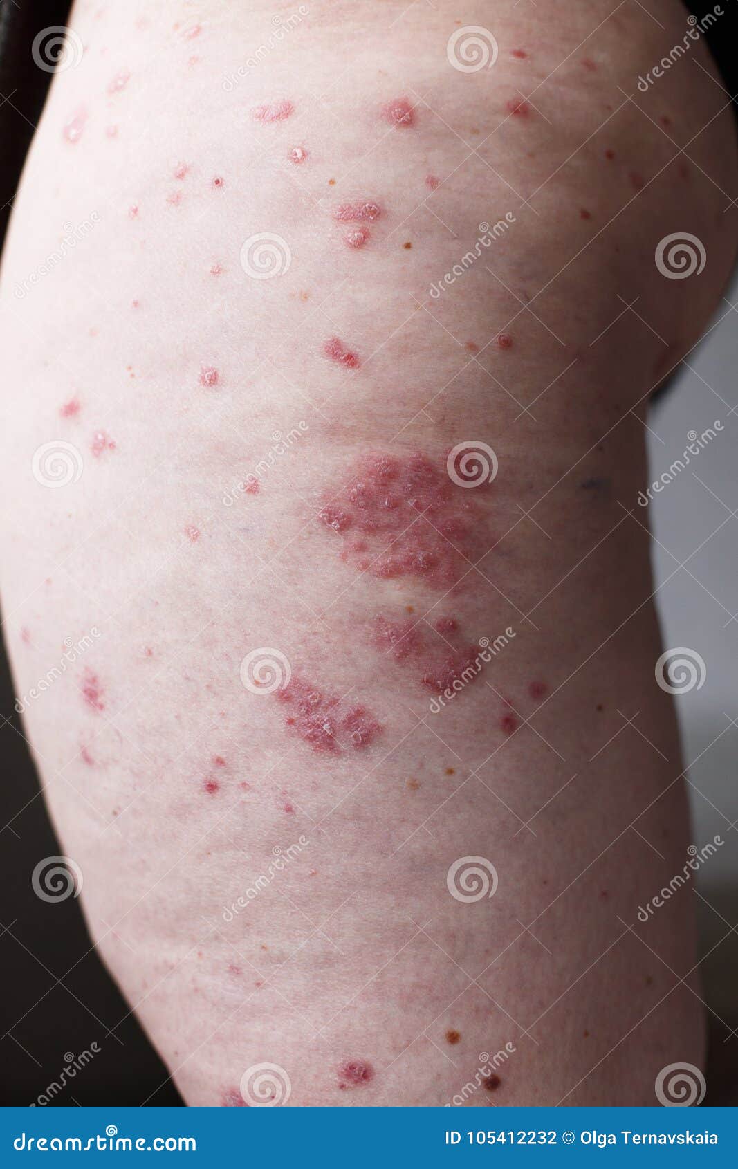 Allergic Rash Dermatitis Eczema Skin on Leg of Patient. Psoriasis and Eczema with Big Red Spots Stock Photo - Image of injury, 105412232