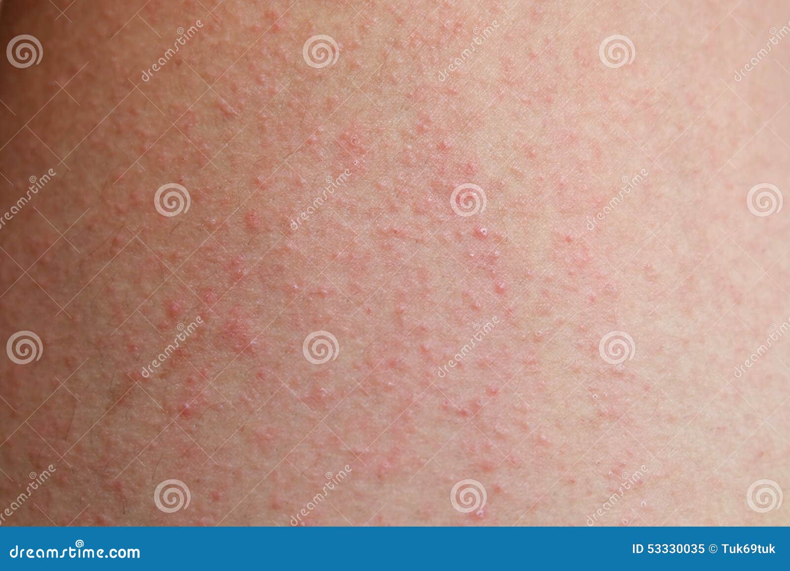 Allergic Rash Dermatitis Skin Stock Image Image Of People Pain 53330035