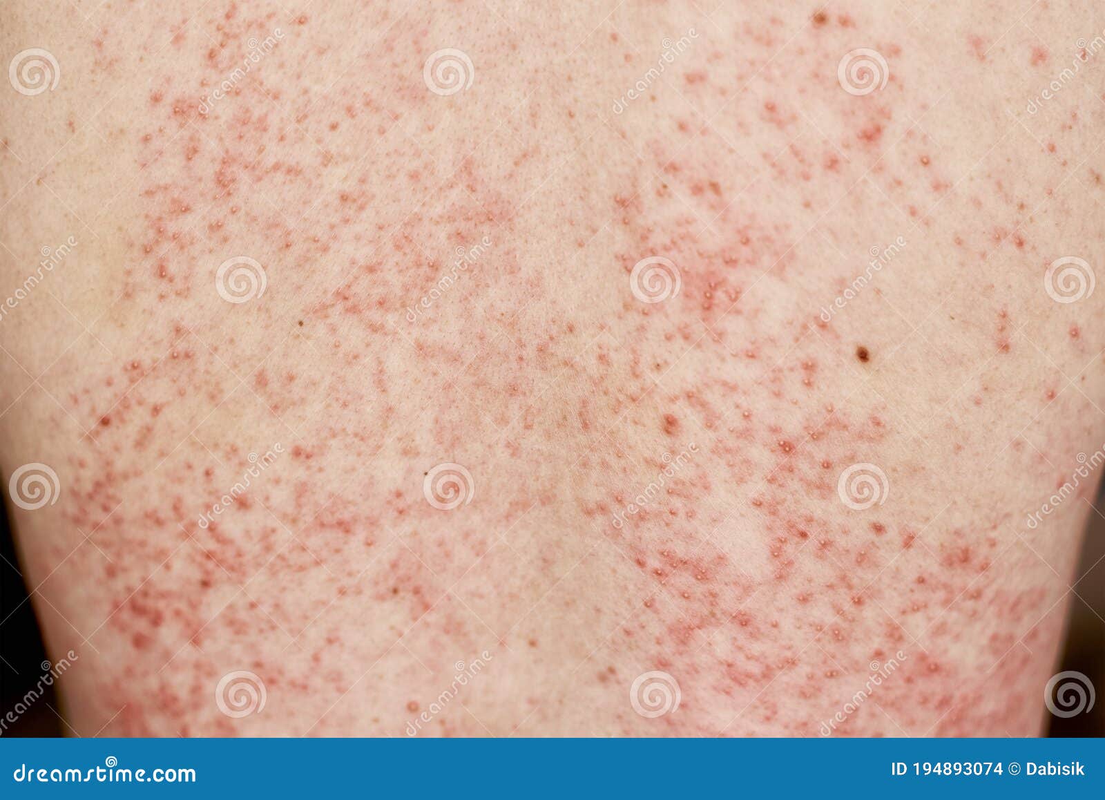 Allergic Rash On Skin Woman With Dermatology Problem On Back Skin