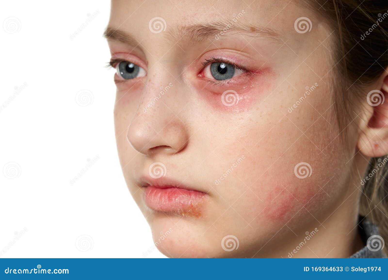 allergic reaction, skin rash, close view portrait of a girl`s face. redness and inflammation of the skin in the eyes and lips.