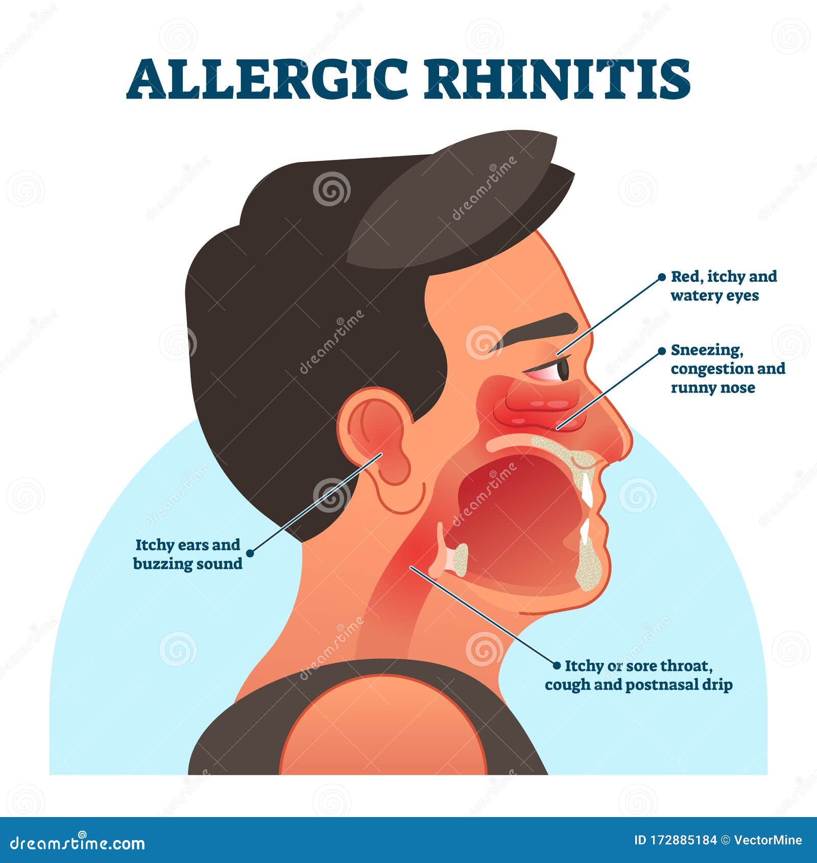Allergic Rhinitis Medical Diagram Vector Illustration Labeled